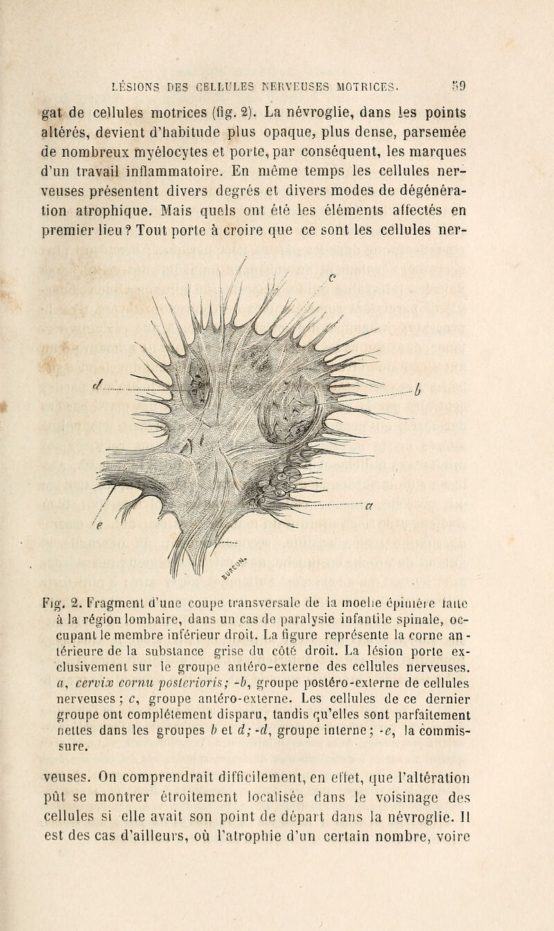 gat de cellules motrices (fig. 2). La névroglie, dans les points altérés, devient d'habitude plus opaque, plus dense, parsemée de nombreux myélocytes et porte, par conséquent, les marques d'un travail inflammatoire. En même temps les cellules ner- veuses présentent divers degrés et divers modes de dégénéra- tion atrophique. Mais quels ont été les éléments affectés en premier lieu? Tout porte à croire que ce sont les cellules ner- Fig. 2. Fragment d'une coupe transversale de la rnoelie épiiuère lailc à la région lombaire, dans un cas de paralysie infantile spinale, oc- cupant le membre inférieur droit. La figure représente la corne an - térieure de la substance grise du côté droit. La lésion porte ex- clusivement sur le groupe antéro-externe des cellules nerveuses. a, cervix cornu posierioris; -6, groupe posléro-exlerne de cellules nerveuses ; c, groupe anléro-exlerne. Les cellules de ce dernier groupe ont complètement disparu, tandis qu'elles sont parfaitement nettes dans les groupes b et d; -d, groupe interne; -e, la commis- sure. veuses. On comprendrait difficilement, en effet, que l'altération pût se montrer étroitement localisée dans le voisinage des cellules si elle avait son point de départ dans la névroglie. Il est des cas d'ailleurs, où l'atrophie d'un certain nombre, voire