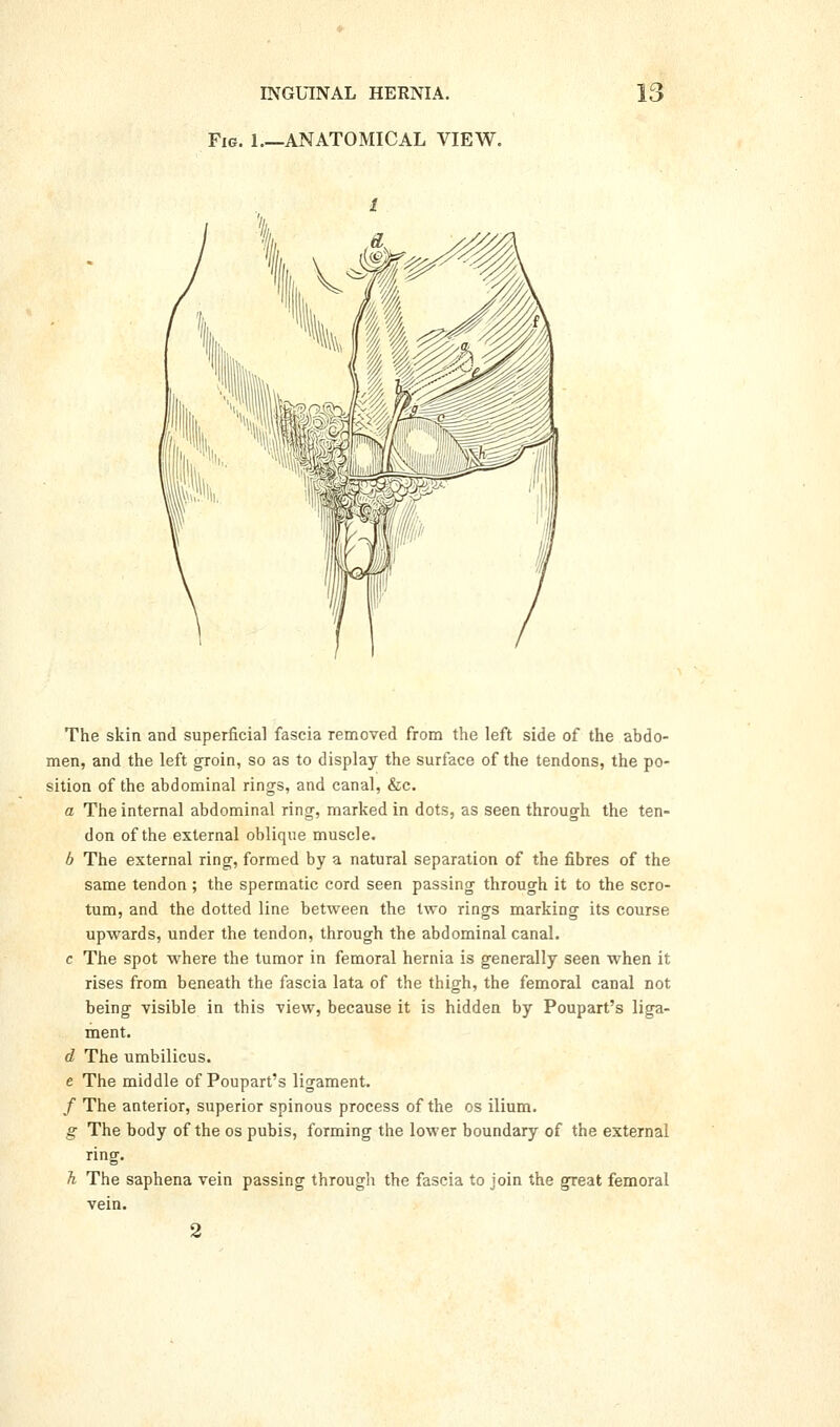 Fig. 1.—anatomical VIEW. The skin and superficial fascia removed from the left side of the abdo- men, and the left groin, so as to display the surface of the tendons, the po- sition of the abdominal rings, and canal, &c. a The internal abdominal ring, marked in dots, as seen through the ten- don of the external oblique muscle. b The external ringf, formed by a natural separation of the fibres of the same tendon ; the spermatic cord seen passing through it to the scro- tum, and the dotted line between the two rings marking its course upwards, under the tendon, through the abdominal canal. c The spot where the tumor in femoral hernia is generally seen when it rises from beneath the fascia lata of the thigh, the femoral canal not being visible in this view, because it is hidden by Poupart's liga- ment. d The umbilicus. e The middle of Poupart's ligament. / The anterior, superior spinous process of the os ilium. g The body of the os pubis, forming tlie lower boundary of the external ring. h, The saphena vein passing through the fascia to join the great femoral vein. 2