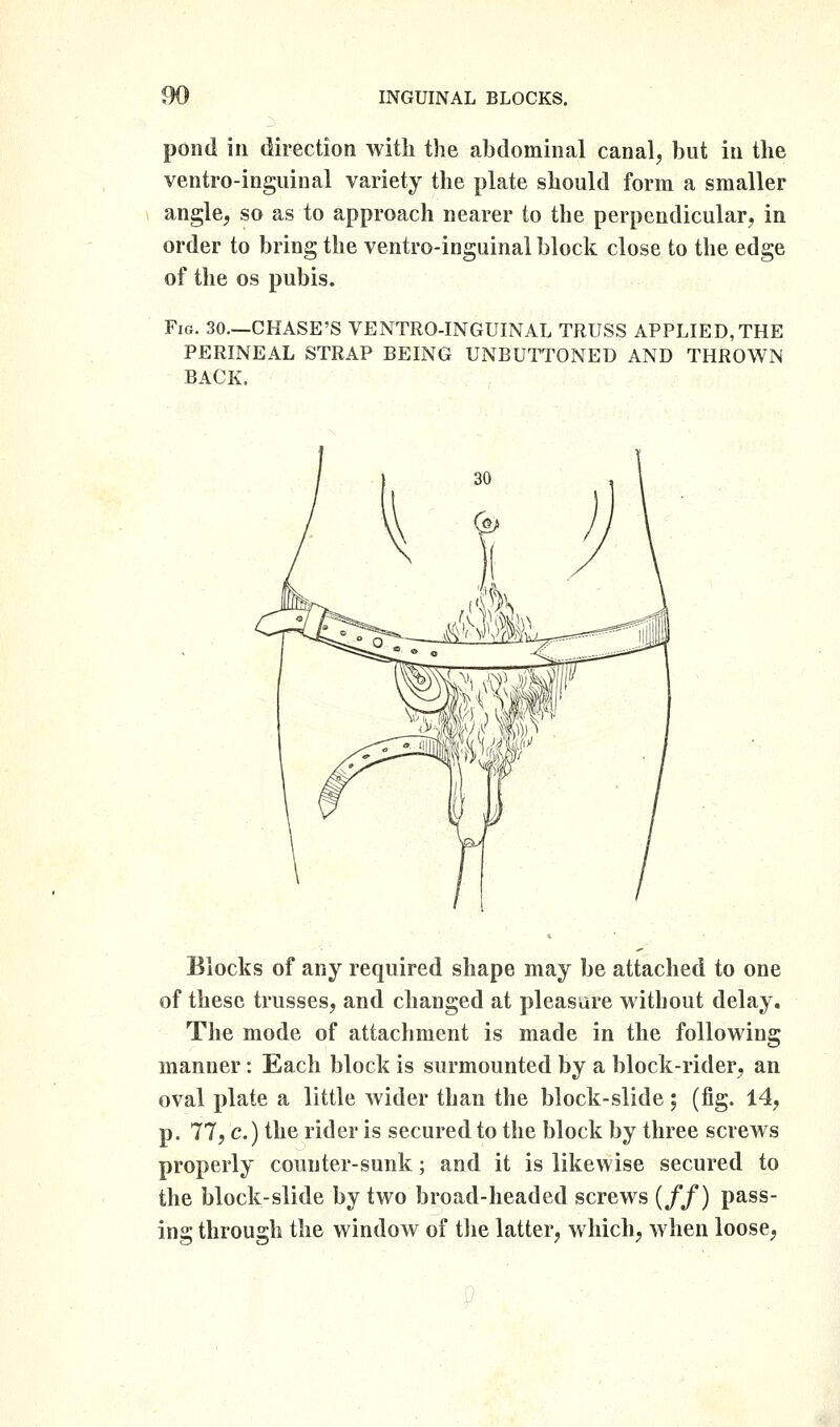 pond ill direction with the abdominal canal, but in the ventro-inguinal variety the plate should form a smaller angle, so as to approach nearer to the perpendicular, in order to bring the ventro-inguinal block close to the edge of the OS pubis. Fig. 30.—CHASE'S VENTRO-INGUINAL TRUSS APPLIED,THE PERINEAL STRAP BEING UNBUTTONED AND THROWN BACK. Blocks of siVij required shape may be attached to one of these ti'usses, and changed at pleasure without delay, Th€ mode of attachment is made in the following manner: Each block is surmounted by a block-rider, an oval plate a little wider than the block-slide; (fig. 14, p. 77, c.) the rider is secured to the block by three screws properly counter-sunk; and it is likewise secured to the block-slide by two broad-headed screws (//) pass- ing through the window of tlie latter, which, when loose,