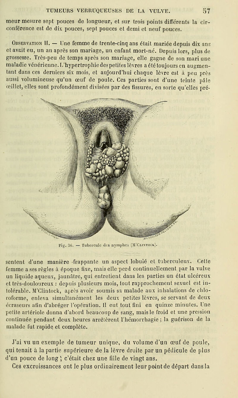 meur mesure sept pouces de longueur, et sur trois points différents la cir- conférence est de dix pouces, sept pouces et demi et neuf pouces. Observation II. — Une femme de trente-cinq ans était mariée depuis dix ans et avait eu, un an après son mariage, un enfant mort-né. Depuis lors, plus de grossesse. Très-peu de temps après son mariage, elle gagne de son mari une maladie vénérienne. L'hypertrophie des petites lèvres a été toujours en augmen- tant dans ces derniers six mois, et aujourd'hui chaque lèvre est à peu près aussi volumineuse qu'un œuf de poule. Ces parties sont d'une teinte pâle œillet, elles sont profondément divisées par des fissures, en sorte qu'elles pré- Fig. 36. — Tubercule des nymphes (M'CuîiTocii), sentent d'une manière frappante un aspect lobule et tuberculeux. Cette femme a ses règles à époque fixe, mais elle perd continuellement par la vulve un liquide aqueux, jaunâtre, qui entretient dans les parties un état ulcéreux et très-douloureux : depuis plusieurs mois, tout rapprochement sexuel est in- tolérable. M'Clintock, après avoir soumis sa malade aux inhalations de chlo- roforme, enleva simultanément les deux petites lèvres, se servant de deux écraseurs afin d'abréger l'opération. 11 eut tout fini en quinze minules. Une pelile artériole donna d'abord beaucoup de sang, mais le froid et une pression continuée pendant deux heures arrêtèrent l'hémorrhagie ; la guérison de la malade fut rapide et complète. J'ai vu un exemple de tumeur unique, du volume d'un œuf de poule, qui tenait à la partie supérieure de la lèvre droite par un pédicule de plus d'un pouce de long ; c'était chez une fille de vingt ans. Ces excroissances ont le plus ordinairement leur point de départ dans la