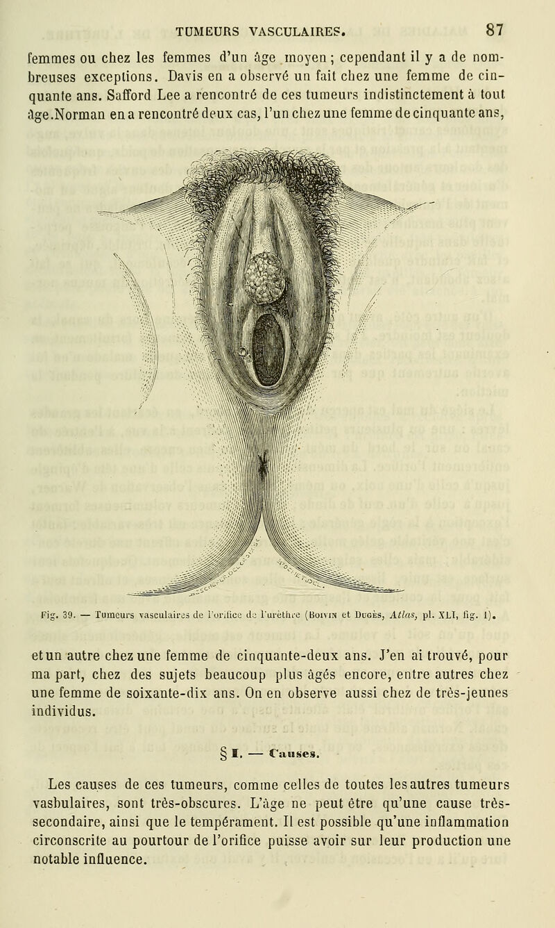 femmes ou chez les femmes d'un âge moyen ; cependant il y a de nom- breuses exceptions. Davis en a observé un fait chez une femme de cin- quante ans. Safford Lee a rencontré de ces tumeurs indistinctement à tout ;lge.Norman en a rencontré deux cas, l'un chez une femme de cinquante ans, Fig. 39. — Tumeurs vasculaires de i'orilice de l'urèthi-e (Boivm et Dugès, Atlas, pi. XLI, fig. I). et un autre chez une femme de cinquante-deux ans. J'en ai trouvé, pour ma part, chez des sujets beaucoup plus âgés encore, entre autres chez une femme de soixante-dix ans. On en observe aussi chez de très-jeunes individus. § I. — Causes. Les causes de ces tumeurs, comme celles de toutes les autres tumeurs vasbulaires, sont très-obscures. L'âge ne peut être qu'une cause très- secondaire, ainsi que le tempérament. Il est possible qu'une inflammation circonscrite au pourtour de l'orifice puisse avoir sur leur production une notable influence.