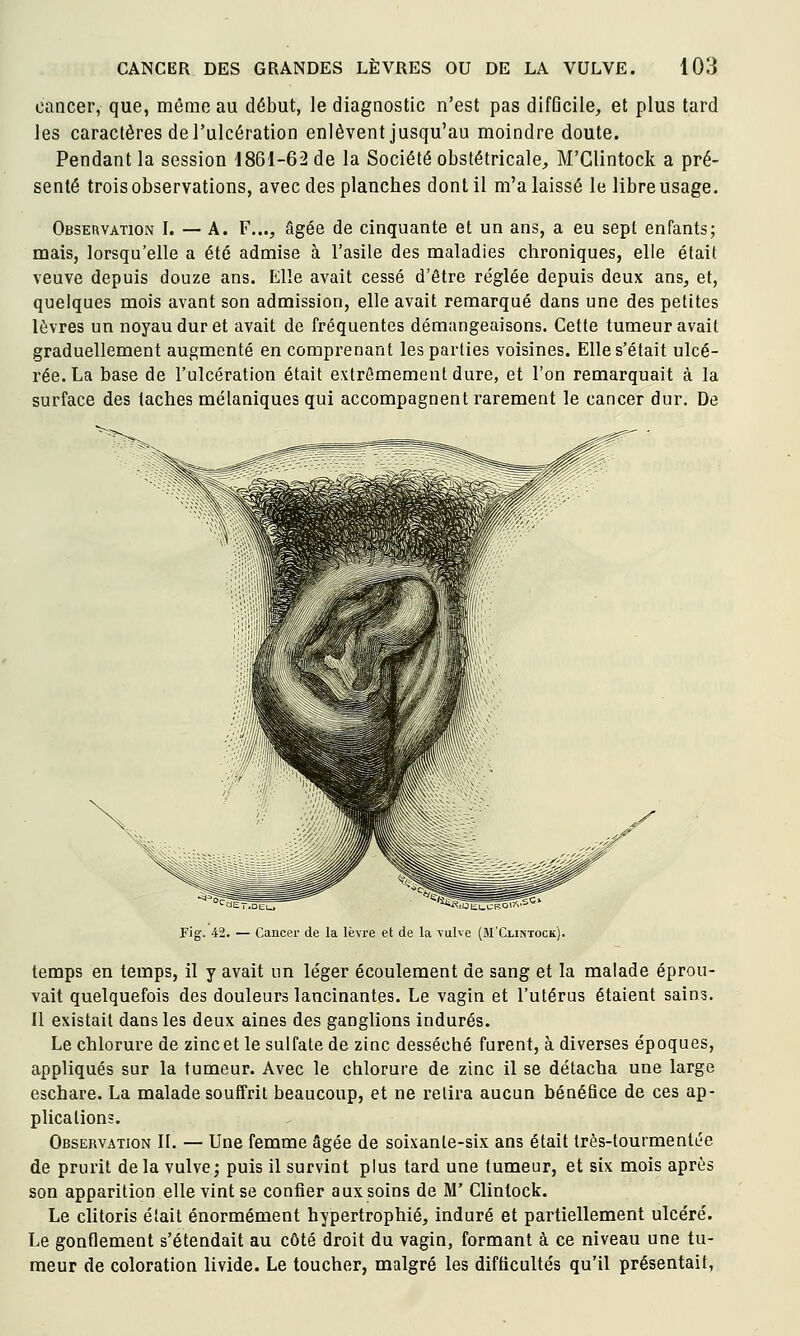 cancer, que, même au début, le diagnostic n'est pas difficile, et plus tard les caractères de l'ulcération enlèvent jusqu'au moindre doute. Pendant la session 1861-62 de la Société obstétricale, M'Glintock a pré- senté trois observations, avec des planches dont il m'a laissé le libre usage. Observation I. — A. F..., âgée de cinquante et un ans, a eu sept enfants; mais, lorsqu'elle a été admise à l'asile des maladies chroniques, elle était veuve depuis douze ans. Elle avait cessé d'être réglée depuis deux ans, et, quelques mois avant son admission, elle avait remarqué dans une des petites lèvres un noyau dur et avait de fréquentes démangeaisons. Cette tumeur avait graduellement augmenté en comprenant les parties voisines. Elle s'était ulcé- rée. La base de l'ulcération était extrêmement dure, et l'on remarquait à la surface des taches mélaniques qui accompagnent rarement le cancer dur. De Fig. 42. — Cancer de la lèvre et de la vulve (M'Clintock). temps en temps, il y avait un léger écoulement de sang et la malade éprou- vait quelquefois des douleurs lancinantes. Le vagin et l'utérus étaient sains. Il existait dans les deux aines des ganglions indurés. Le chlorure de zinc et le sulfate de zinc desséché furent, à diverses époques, appliqués sur la tumeur. Avec le chlorure de zinc il se détacha une large eschare. La malade souffrit beaucoup, et ne relira aucun bénéfice de ces ap- plications. Observation II. — Une femme âgée de soixante-six ans était très-tourmentée de prurit de la vulve; puis il survint plus tard une tumeur, et six mois après son apparition elle vint se confier aux soins de M' Clinlock. Le clitoris était énormément hypertrophié, induré et partiellement ulcéré. Le gonflement s'étendait au côté droit du vagin, formant à ce niveau une tu- meur de coloration livide. Le toucher, malgré les difficultés qu'il présentait,