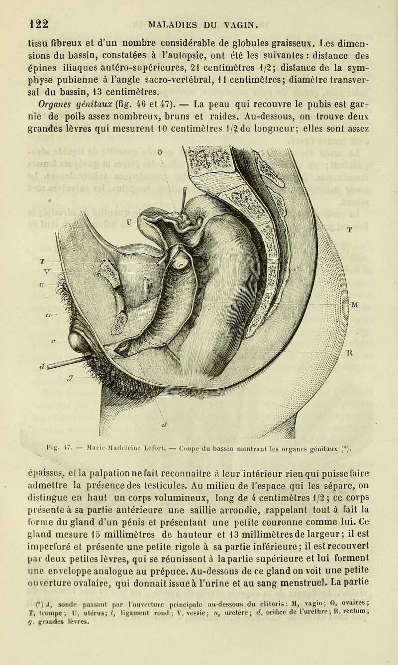 tissu fibreux et d'un nombre considérable de globules graisseux. Les dimen- sions du bassin, constatées à l'autopsie, ont été les suivantes: distance des épines iliaques antéro-supérieures, 21 cenlimètres 1/2; distance de la sym- physe pubienne à l'angle sacro-vertébral, 11 centimètres; diamètre transver- sal du bassin, 13 centimètres. Organes génitaux (fig. 46 et 47). — La peau qui recouvre le pubis est gar- nie de poils assez nombreux, bruns et raides. Au-dessous, on trouve deux grandes lèvres qui mesurent 10 centimètres 1/2 de longueur; elles sont assez l'ifç. 47. — Mdiic Madeleine Lefort. — Coupe du bassin montrant les organes génitaux (*). épaisses, et la palpationnefait reconnaître à leur intérieur rien qui puisse faire admettre la présence des testicules. Au milieu de l'espace qui les sépare, on distingue en haut un corps volumineux, long de 4 cenlimètres 1/2; ce corps présente à sa partie antérieure une saillie arrondie, rappelant tout à fait la forme du gland d'un pénis et présentant une petite couronne comme lui. Ce gland mesure 15 millimètres de hauteur et 13 millimètres de largeur; il est imperforé et présente une petite rigole à sa partie inférieure; il est recouvert pai- deux petites lèvres, qui se réunissent à la partie supérieure et lui forment une enveloppe analogue au prépuce. Au-dessous de ce gland on voit une petite ouverture ovalaire, qui donnait issue à l'urine et au sang menstruel. La partie (•) J, sondfi passant par l'ouverture principale au-dessous du clitoris: M, vagin; 0, ovaires; T, trompe; IJ, utérus; /, ligament rond ; V, vessie; u, uretère; d, orifice de i'urèthre; R, rectum; (/, grandes lèvres.