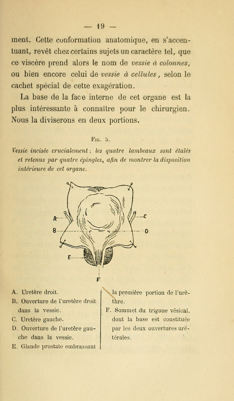 ment. Cette conformation anatomique, en s'aceen- tuant, revêt chez certains sujets un caractère tel, que ce viscère prend alors le nom de vessie à colonnes, ou bien encore celui de vessie à cellules, selon le cachet spécial de cette exagération. La base de la face interne de cet organe est la plus intéressante à connaître pour le chirurgien. Nous la diviserons en deux portions. Fig. 5. Vessie incisée crucialement -, les quatre lambeaux sont étalés et retenus par quatre épingles, afin de montrer la disposition intérieure de cet organe. A. Uretère droit. B. Ouverture de l'uretère droit dans la vessie. G. Uretère gauche. D. Ouverture de l'uretère gau- che dans la vessie. E. Glande prostate embrassant la première portion de l'urè- thre. F. Sommet du trigone vésieal. dont la base est constituée par les deux ouvertures uré- térales.