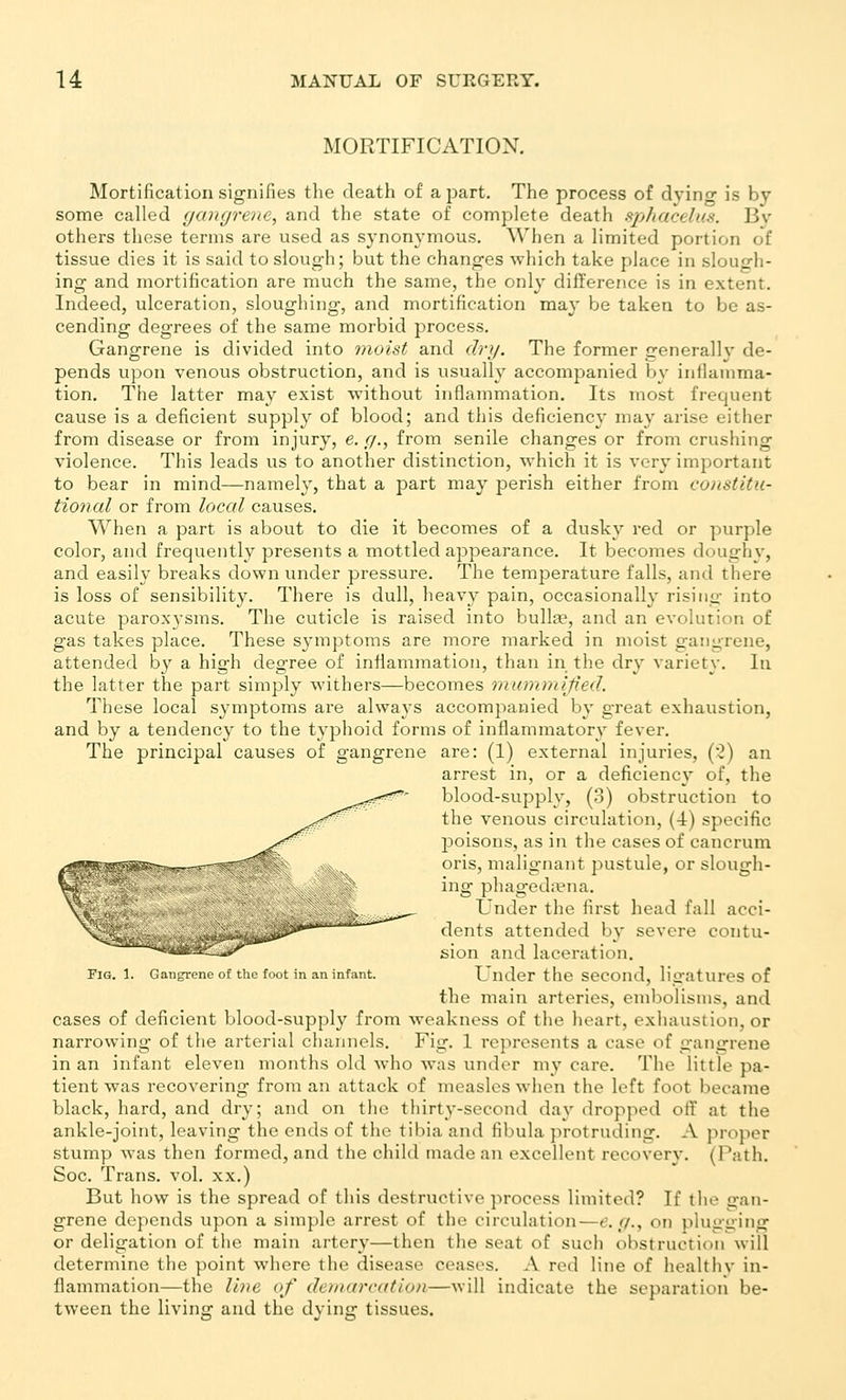 MORTIFICATION. Mortification signifies tlie death of a part. The process of dying is by some called gangrene, and the state of complete death sphacelus. Bv others these terms are used as synonymous. When a limited portion of tissue dies it is said to slough; but the changes which take place in slough- ing and mortification are much the same, the only difference is in extent. Indeed, ulceration, sloughing, and mortification may be taken to be as- cending degrees of the same morbid process. Gangrene is divided into vioist and drg. The former generallv de- pends upon venous obstruction, and is usually accompanied by inflamma- tion. The latter may exist without inflammation. Its most frequent cause is a deficient supply of blood; and this deficiency may arise either from disease or from injury, e. g., from senile changes or from crushing violence. This leads us to another distinction, which it is very important to bear in mind—nameh', that a part may perish either from constitu- tional or from local causes. When a part is about to die it becomes of a dusky red or purple color, and frequently presents a mottled appearance. It becomes doughy, and easily breaks down under pressure. The temperature falls, and there is loss of sensibility. There is dull, heavy pain, occasionally rising into acute paroxysms. The cuticle is raised into bulla^, and an evolution of gas takes place. These symptoms are more marked in moist gangrene, attended by a high degree of inflammation, than in the dry variety. In the latter the part simply withers—becomes mummified. These local symptoms are always accompanied by great exhaustion, and by a tendency to the typhoid forms of inflammatory fever. The principal causes of gangrene are: (1) external injuries, (2) an arrest in, or a deficiency of, the blood-supply, (3) obstruction to the venous circulation, (4) specific jDoisons, as in the cases of cancrum oris, malignant pustule, or slough- ing phaged;ena. Under the first head fall acci- dents attended by severe contu- sion and laceration. Fig. 1. Gangrene of the foot in an infant. Under the Second, ligatures of the main arteries, embolisms, and cases of deficient blood-supply from weakness of the heart, exhaustion, or narrowing of the arterial channels. Fig. 1 represents a case of gangrene in an infant eleven months old who was under my care. The little pa- tient was recovering from an attack of measles when the left foot became black, hard, and dry; and on the thirty-second day dropped off at tlie ankle-joint, leaving the ends of the tibia and fibula protruding. A proper stump was then formed, and the child made an excellent recovery. (Path. Soc. Trans, vol. xx.) But how is the spread of this destructive process limited? If the gan- grene depends upon a simple arrest of the circulation—e.g., on phmuing or deligation of the main artery—then the seat of such obstruction will determine the point where the disease ceases. A red line of healthv in- flammation—the line of demarcation—will indicate the separation be- tween the living and the dving tissues.