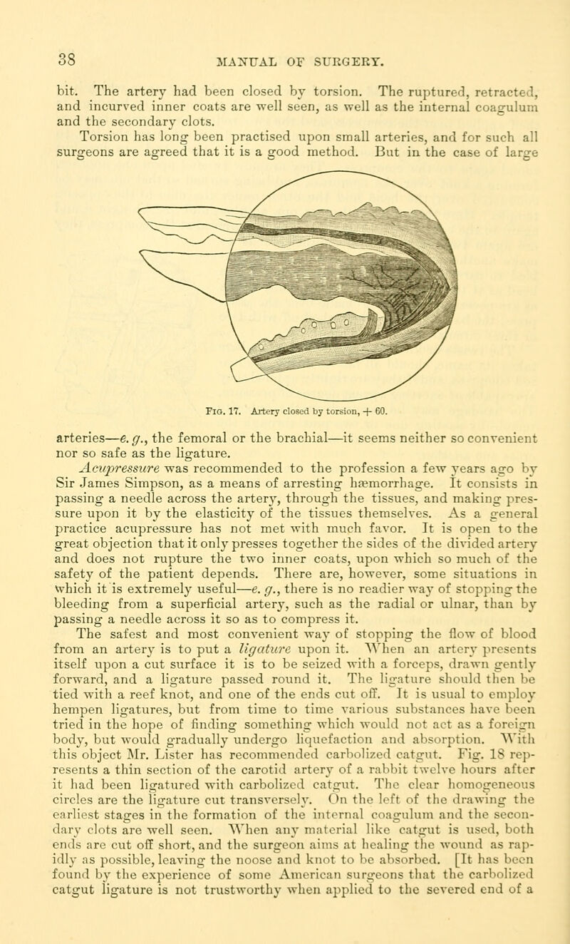 bit. The artery had been closed by torsion. The ruptured, retracted, and incurved inner coats are well seen, as well as the internal coagulum and the secondary clots. Torsion has long been practised upon small arteries, and for such all surgeons are agreed that it is a good method. But in the case of large Fig. 17. Artery closed by torsion, + 60. arteries—e.g., the femoral or the brachial—it seems neither so convenient nor so safe as the ligature. Acvjyressure was recommended to the profession a few years ago by Sir James Simpson, as a means of arresting haemorrhage. It consists in passing a needle across the artery, through the tissues, and making pres- sure upon it by the elasticity of the tissues themselves. As a general practice acupressure has not met with much favor. It is open to the great objection that it only presses together the sides of the divided artery and does not rupture the two inner coats, upon which so much of the safety of the patient depends. There are, however, some situations in which it is extremely useful—e. g., there is no readier wa}' of stopping the bleeding from a superficial artery, such as the radial or ulnar, than by passing a needle across it so as to compress it. The safest and most convenient way of stopping the flow of blood from an artery is to put a ligature upon it. When an artery presents itself upon a cut surface it is to be seized with a forceps, drawn gently forward, and a ligature passed round it. The ligature should then be tied with a reef knot, and one of the ends cut off. It is usual to employ hempen ligatures, but from time to time various substances have been tried in the hope of finding something which would not act as a foreign body, but would gradually undergo liquefaction and absorption. NVitli this object Mr. Lister has recommended carbolized catgut. Fig. 18 rep- resents a thin section of the carotid artery of a rabbit twelve hours after it had been ligatured with carbolized catgut. The clear homogeneous circles are the ligature cut transversely. On the left of the drawing the earliest stages in the formation of the internal coagulum and the secon- dary clots are well seen. When any material like catgut is used, both ends are cut off short, and the surgeon aims at healing the wound as rap- idly as possible, leaving the noose and knot to be absorbed, [It has been found by the experience of some American surgeons that the carbolized catgut ligature is not trustworthy when applied to the severed end of a