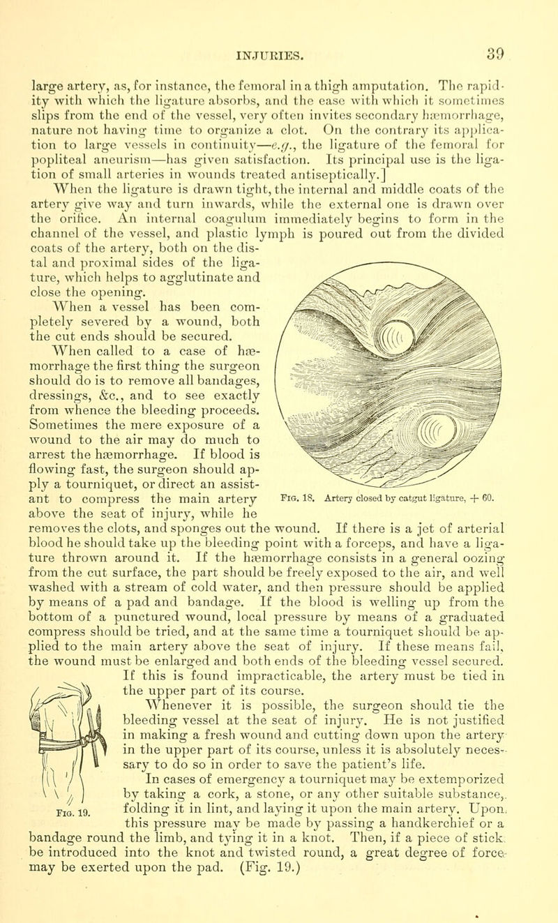 large artery, as, for instance, the femoral in a thigh amputation. The rapid- ity with which the ligature absorbs, and the ease with which it sometiiiies slips from the end of tlie vessel, very often invites secondary hicinorrliage, nature not having time to organize a clot. On the contrary its ap])lica- tion to large vessels in continuity—e.r/., the ligature of the femoral for popliteal aneurism—has given satisfaction. Its principal use is the liga- tion of small arteries in wounds treated antiseptically.] When the ligature is drawn tight, the internal and middle coats of the artery give way and turn inwards, while the external one is drawn over the orifice. An internal coagulum immediately begins to form in the channel of the vessel, and plastic lymph is poured out from the divided coats of the artery, both on the dis- tal and proximal sides of the liga- ture, which helps to agglutinate and close the opening. When a vessel has been com- pletely severed by a wound, both the cut ends should be secured. When called to a case of hre- morrhaare the first thina: the sura^eon should do is to remove all bandages, dressings, &c., and to see exactly from whence the bleeding proceeds. Sometimes the mere exposure of a wound to the air may do much to arrest the hjemorrhage. If blood is flowing fast, the surgeon should ap- ply a tourniquet, or direct an assist- ant to compress the main artery above the seat of injury, while he removes the clots, and sponges out the wound. If there is a jet of arterial blood he should take up the bleeding point with a forceps, and have a liga- ture thrown around it. If the haemorrhage consists in a general oozing from the cut surface, the part should be freely exposed to the air, and well washed with a stream of cold water, and then pressure should be applied by means of a pad and bandage. If the blood is welling up from the bottom of a punctured wound, local pressure by means of a graduated compress should be tried, and at the same time a tourniquet should be ap- plied to the main artery above the seat of injury. If these means fail, the wound must be enlarg-ed and both ends of the bleedino: vessel secured. If this is found impracticable, the artery must be tied in the upper part of its course. Whenever it is possible, the surgeon should tie the bleeding vessel at the seat of injury. He is not justified in making a fresh wound and cutting down upon the artery in the upper part of its course, unless it is absolutely neces^- sary to do so in order to save the patient's life. In cases of emergency a tourniquet may be extemporized by taking a cork, a stone, or any other suitable substance,. folding it in lint, and laying it upon the main artery. Upon, this pressure may be made by passing a handkerchief or a bandage round the limb, and tying it in a knot. Then, if a piece of stick be introduced into the knot and twisted round, a great degree of forcec may be exerted upon the pad. (Fig. 19.) Fig. 18. Artery closed by catgut ligature, + 60. Fia. 19.