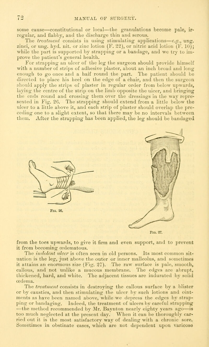 some cause—constitutional or local—the granulations become pale, ir- regular, and flabby, and the discharge thin and serous. The treatment consists in using stimulating applications—e.g., ung. zinci, or ung. hyd. nit. or zinc lotion (F. 22), or nitric acid lotion (F. 10); while the jjart is supported by strapping or a bandage, and we try to im- prove the patient's general health. For strapping an ulcer of the leg tiie surgeon should provide himself with a number of strips of adhesive plaster, about an inch broad and long enough to go once and a half round the part. The patient should be dii-ected to place his heel on the edge of a chair, and then the surgeon should apply the strips of plaster in regular order from below upwards, laying the centre of the strip on the limb opposite the ulcer, and bringing the ends round and crossing them over the dressings in the way repre- sented in Fig. 26. The strapping should extend from a little below the ulcer to a little above it, and each strip of plaster should overlap the pre- ceding one to a slight extent, so that there ma}'- be no intervals between them. After the strapping has been applied, the leg should be bandaged Tig. 26, Fia. 27. from the toes upwards, to give it firm and even support, and to prevent it from becoming oedematous. The indolent ulcer is often seen in old persons. Its most common sit- uation is the leg, just above the outer or inner malleolus, and sometimes it attains an enormous size (Fig. 27). The raw surface is pale, smooth, callous, aTid not unlike a mucous membrane. The edges are alirupt, thickened, hard, and white. The adjacent tissues are indurated by solid oedema. The treatment consists in destroving the callous surface by a l)lister or by caustics, and then stimulating the ulcer by such lotions and oint- ments as have been named above, wliile we depress tlie edges by strap- ping or bandaging. Indeed, the treatment of ulcers l\v careful strapping —the method recommended by Mr. Baynton nearly eighty years ago—is too much neglected at the present day. When it can be thoroughly car- ried out it is the most satisfactory way of dealing with a chronic sore. Sometimes in obstinate cases, which are not dependent upon varicose