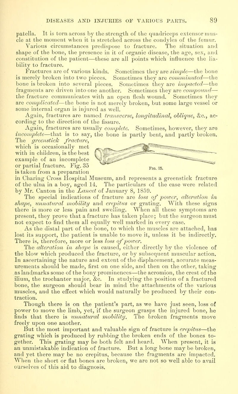 Fig. 35. patella. It is torn across by tlic strength of the quadriceps extensor iiiu.s- cle at the moment when it is stretched across the condyles of the femur. Various circumstances predispose to fracture. The situation and shape of the bone, the presence in it of organic disease, the age, sex, and constitution of the patient—these are all points which influence the lia- bility to fracture. Fractures are of various kinds. Sometimes they are simple—the bone is merely broken into two pieces. Sometimes they are coimniniited—the bone is broken into several pieces. Sometimes they are impacted—the fragments are driven into one another. Sometimes they are compound— the fracture communicates with an open flesh wound. Sometimes they are complicated—the bone is not merely broken, but some large vessel or some internal organ is injured as well. Again, fractures are named transverse, longitudinal, oblique, &c., ac- cording to the direction of the fissure. Again, fractures are usually complete. Sometimes, however, they are incomplete—that is to say, the bone is partly bent, and partly broken. The greenstick fracture, which is occasionally met with in children, is the best example of an incomplete or partial fi-acture. Fig. 35 is taken from a preparation in Charing Cross Hospital Museum, and represents a greenstick fracture of the ulna in a boy, aged 14. The particulars of the case were related by Mr. Canton in the Lancet of January 8, 1859. The special indications of fracture are loss of p)0iGer, alteration in shape, unnatural niohility and crepitus or grating. With these signs there is more or less pain and swelling. When all these symptoms are present, they prove that a fracture has taken place; but the surgeon must not expect to find them all equally well marked in every case. As the distal part of the bone, to which the muscles are attached, has lost its support, the patient is unable to move it, unless it be indirectly. Thei'e is, therefore, more or less loss of poioer. The alteration in shape is caused, either directly by the violence of the blow which produced the fracture, or by subsequent muscular action. In ascertaining the nature and extent of the displacement, accurate meas- urements should be made, first on one side, and then on the other, taking as landmarks some of the bony prominences—the acromion, the crest of the ilium, the trochanter major, &c. In studying the position of a fractured bone, the surgeon should bear in mind the attachments of the various muscles, and the effect which would naturally be produced by their con- traction. Though there is on the patient's part, as we have just seen, loss of power to move the limb, yet, if the surgeon grasps the injured bone, he finds that there is unnatural mohilitg. The broken fragments move freely upon one another. But the most important and valuable sign of fracture is crepitus—the grating which is produced by rubbing the broken ends of the bones to- gether. This grating may be both felt and heard. When present, it is an unmistakable indication of fracture. But a long bone may be broken, and yet there may be no crepitus, because the fragments are impacted. When the short or flat bones are broken, we are not so well able to avail ourselves of this aid to diaanosis.