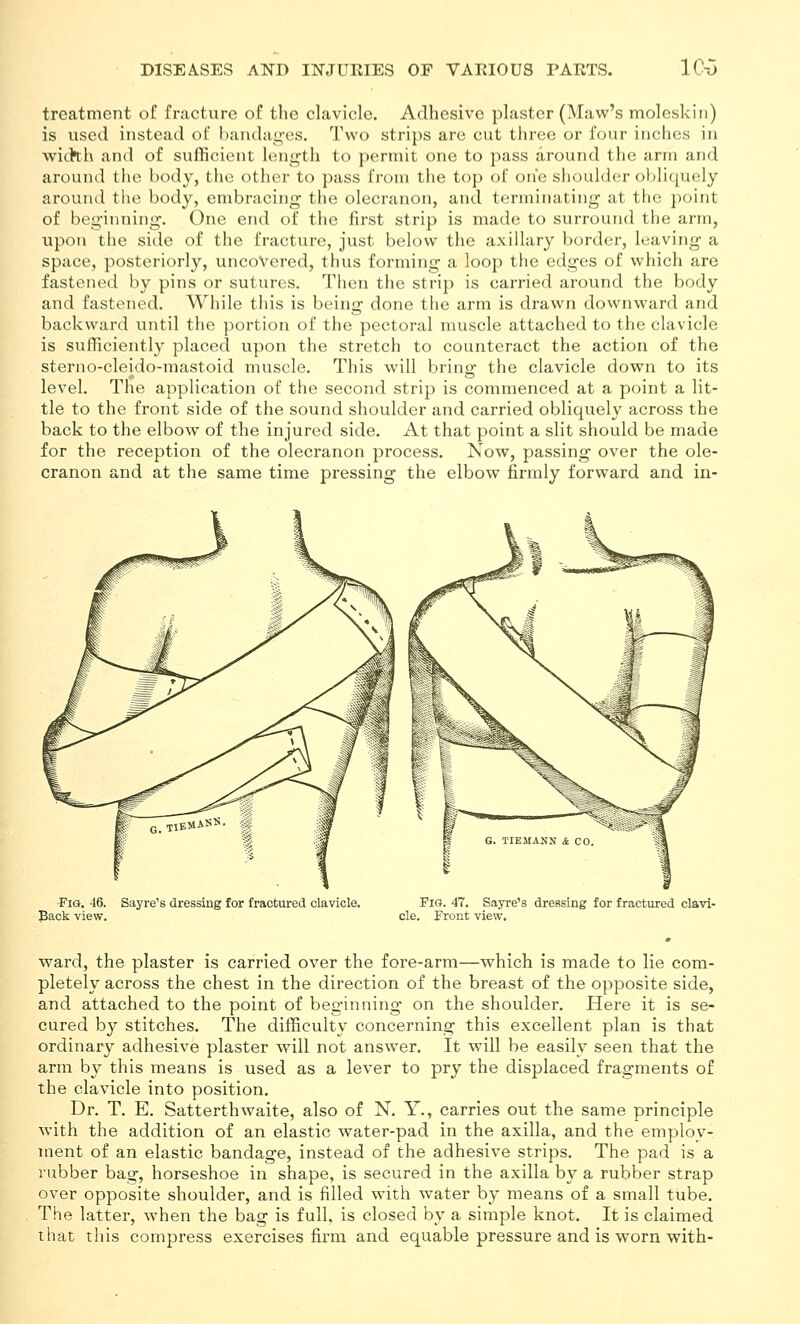 treatment oC fracture of the clavicle. Adhesive plaster (Maw's moleskin) is used instead of banduj^-es. Two strips are cut three or four inches in wid^h and of sufficient length to permit one to pass around the arm and around tlie body, the other to pass from the top of one shoulder obliquely around tiie body, embracing the olecranon, and terminating at the point of beginning. One end of the first strip is made to surround the arm, upon the side of the fracture, just below the axillary border, leaving a space, posteriorly, uncovered, thus forming a loop the edges of which are fastened by pins or sutures. Then the strip is carried around the body and fastened. While this is being done the arm is drawn dovvnward and backward until the portion of the pectoral muscle attached to the clavicle is sufficiently placed upon the stretch to counteract the action of the sterno-cleido-mastoid muscle. This will bring the clavicle down to its level. The application of the second strip is commenced at a point a lit- tle to the front side of the sound shoulder and carried obliquely across the back to the elbow of the injured side. At that point a slit should be made for the reception of the olecranon process. Now, passing over the ole- cranon and at the same time pressing the elbow firmly forward and in- FiG. 46. Sayre's dressing for fractured clavicle. Pig. 47. Sayre's dressing for fractured clavi- Back view. cle. Front view. ward, the plaster is carried over the fore-arm—which is made to lie com- pletely across the chest in the direction of the breast of the opposite side, and attached to the point of beginning on the shoulder. Here it is se- cured by stitches. The difficulty concerning this excellent plan is that ordinary adhesive plaster will not answer. It will be easily seen that the arm by this means is used as a lever to pry the displaced fragments of the clavicle into position. Dr. T. E. Satterthwaite, also of N. Y., carries out the same principle with the addition of an elastic water-pad in the axilla, and the emplov- ment of an elastic bandage, instead of the adhesive strips. The pad is a rubber bag, horseshoe in shape, is secured in the axilla by a rubber strap over opposite shoulder, and is filled with water by means of a small tube. The latter, when the bag is full, is closed by a simple knot. It is claimed that this compress exercises firm and equable pressure and is worn with-