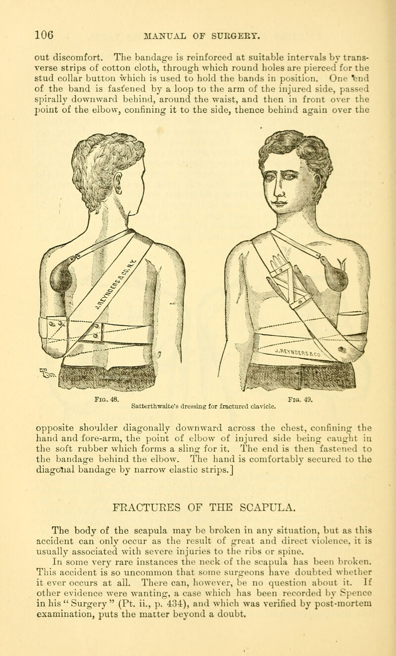 out discomfort. Tlie bandage is reinforced at suitable intervals by trans- verse strips of cotton cloth, through which round holes are pierced for the stud collar button which is used to hold the bands in position. One Isnd of the band is fast'ened by a loop to the arm of the injured side, passed spirally downward behind, around the waist, and then in front over the point of the elbow, confining it to the side, thence behind again over the Fig. 48. Satterthwaite''s dressing for fractured clavicle. Fig. 49. opposite shoulder diagonally downward across the chest, confining the hand and fore-arm, the point of elbow of injured side being caught in the soft rubber which forms a sling for it. The end is then fastened to the bandage behind the elbow. The hand is comfortably secured to the diagolial bandage by narrow elastic strips.] FRACTURES OF THE SCAPULA. The body of the scapula may be broken in any situation, but as this accident can only occur as the result of great and direct violence, it is usually associated with severe injuries to the ribs or spine. In some verj^ rare instances the neck of the scapula has been broken. This accident is so uncommon that some surgeons have doubted whether it ever occurs at all. There can, however, be no question about it. If other evidence were wanting, a case which has been recorded by Spence in his Surgery (Pt. ii., p. 434), and which was verified by post-mortem examination, puts the matter beyond a doubt.