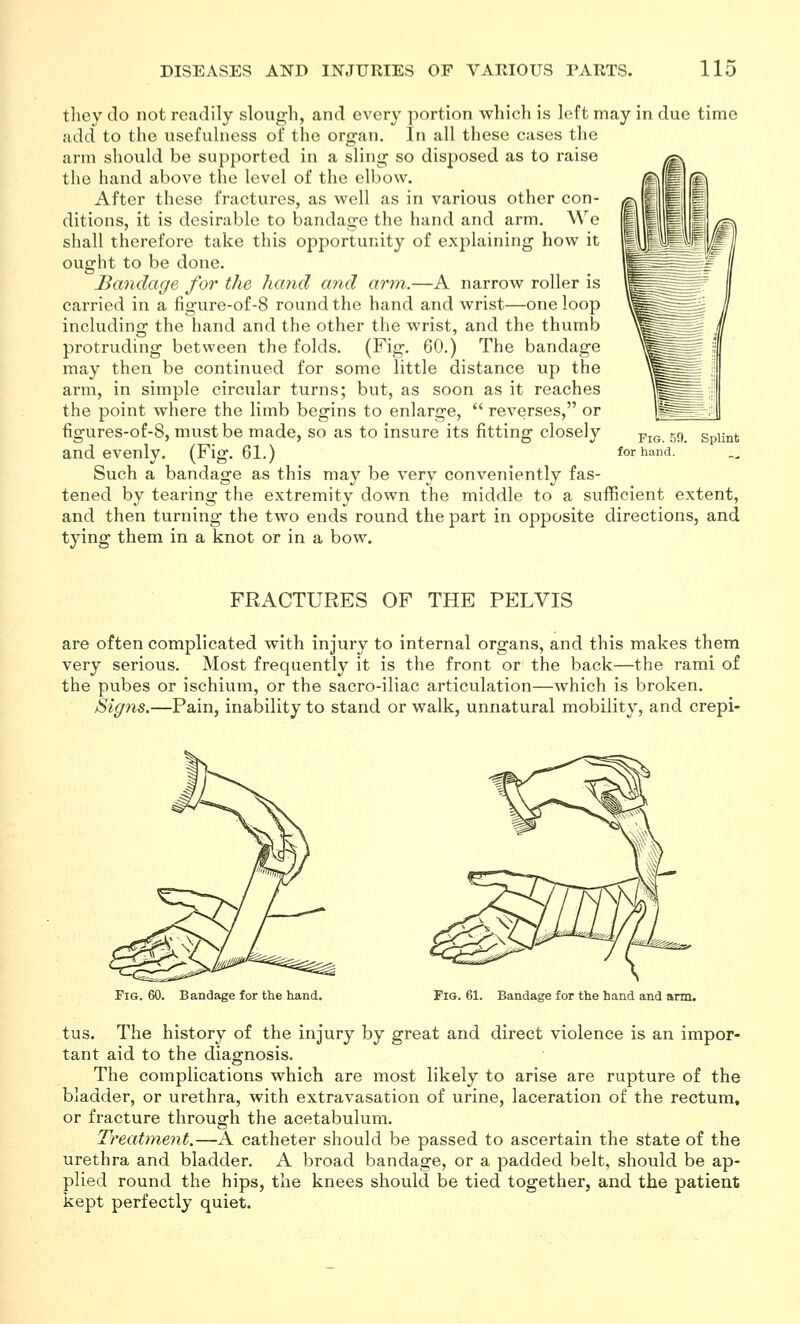 tlicy do not readily slough, and every portion which is left may in due time add to the usefulness of the organ. In all these cases the arm should be supported in a sling so disposed as to raise the hand above the level of the elbow. After these fractures, as well as in various other con- ditions, it is desirable to bandage the hand and arm. We shall therefore take this opportunity of exj^laining how it ought to be done. Bandage for the hand and arm.—A narrow roller is carried in a figure-of-8 round the hand and wrist—one loop including the hand and the other the wrist, and the thumb protruding between the folds. (Fig. 60.) The bandage may then be continued for some little distance up the arm, in simple circular turns; but, as soon as it reaches the point where the limb begins to enlarge,  reverses, or figures-of-8, must be made, so as to insure its fitting closely and evenly. (Fig. 61.) Such a bandage as this may be very conveniently fas- tened by tearing the extremity down the middle to a sufficient extent, and then turning the two ends round the part in opposite directions, and tying them in a knot or in a bow. Splint FRACTURES OF THE PELVIS are often complicated with injury to internal organs, and this makes them very serious. Most frequently it is the front or the back—the rami of the pubes or ischium, or the sacro-iliac articulation—which is broken. Signs.—Pain, inability to stand or walk, unnatural mobility, and crepi- FiG. 60. Bandage for the hand. Fio. 61. Bandage for the hand and arm. tus. The history of the injury by great and direct violence is an impor- tant aid to the diagnosis. The complications which are most likely to arise are rupture of the bladder, or urethra, with extravasation of urine, laceration of the rectum, or fracture through the acetabulum. Treatment.—A catheter should be passed to ascertain the state of the urethra and bladder. A broad bandage, or a padded belt, should be ap- plied round the hips, the knees should be tied together, and the patient kept perfectly quiet.