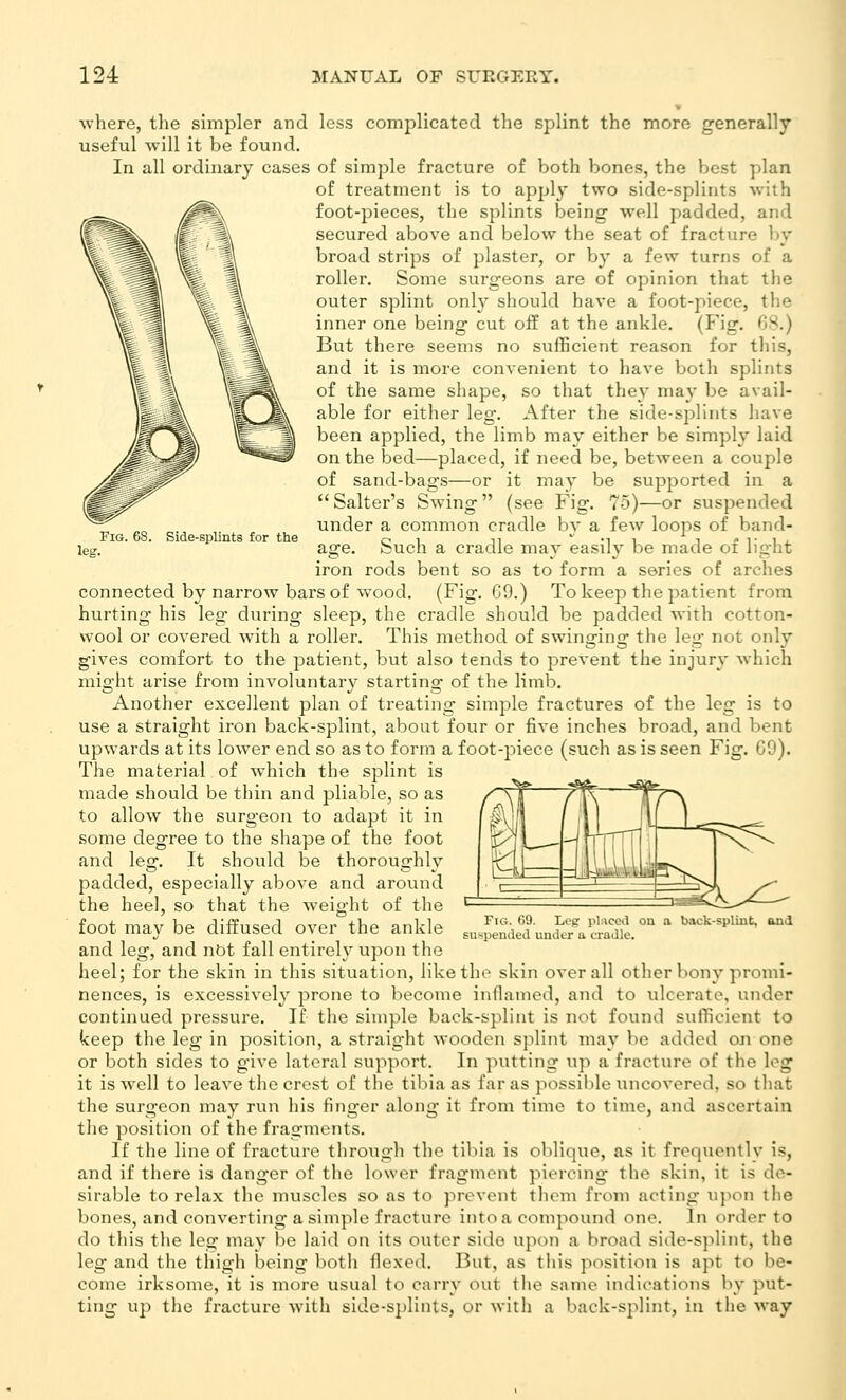 leg. Fig. 68. Side-splints for the ■where, the simpler and less complicated the splint the more generally useful will it be found. In all ordinary cases of simple fracture of both bones, the best plan of treatment is to apply two side-splints with foot-pieces, the splints being well padded, and secured above and below the seat of fracture by broad strips of plaster, or by a few turns of a roller. Some surgeons are of opinion that the outer splint only should have a foot-piece, the inner one being cut off at the ankle. (Fig. OS.) But there seems no sufficient reason for this, and it is more convenient to have both splints of the same shape, so that they may be avail- able for either leg. After the side-splints liave been applied, the limb may either be simply laid on the iDcd—placed, if need be, between a couple of sand-bags—or it may be supported in a Salter's Swing (see Fig. 75)—or suspended under a common cradle by a few loops of band- age. Such a cradle may easily be made of light iron rods bent so as to form a series of arches connected by narrow bars of wood. (Fig. G9.) To keep the patient from hurting his leg during sleep, the cradle should be padded with cotton- wool or covered with a roller. This method of swinging the leg not only gives comfort to the patient, but also tends to prevent the injury which might arise from involuntary starting of the limb. Another excellent plan of treating simple fractures of the leg is to use a straight iron back-splint, about four or five inches broad, and bent upwards at its lower end so as to form a foot-piece (such as is seen Fig. C9). The material of which the splint is made should be thin and pliable, so as to allow the surgeon to adapt it in some degree to the shape of the foot and leg. It should be thoroughly padded, especially above and around the heel, so that the weight of the foot may be diffused over the ankle and leg, and nbt fall entirely upon the heel; for the skin in this situation, like the skin overall other bony promi- nences, is excessively prone to become inflamed, and to ulcerate, under continued pressitre. If the simple back-splint is not found sufficient to keep the leg in position, a straight wooden splint may be added on one or both sides to give lateral support. In putting up a fracture of the log it is well to leave the crest of the tibia as far as possible uncovered, so that the surgeon may run his finger along it from time to time, and ascertain the position of the fragments. If the line of fracture through the tibia is oblique, as it froquonllv is, and if there is danger of the lower fragment piercing the skin, it is de- sirable to relax the muscles so as to prevent them from acting upon the bones, and converting a simple fracture into a compound one. In order to do this the leg may be laid on its outer side upon a broad side-splint, the leg and the thigh being both flexed. But, as tliis position is apt to be- come irksome, it is more usual to carry out the same indications by put- ting up the fracture with side-splints, or with a back-splint, in the way Fut. 69. Leg pliiced on a back-spUut, and suspended under a cradle.