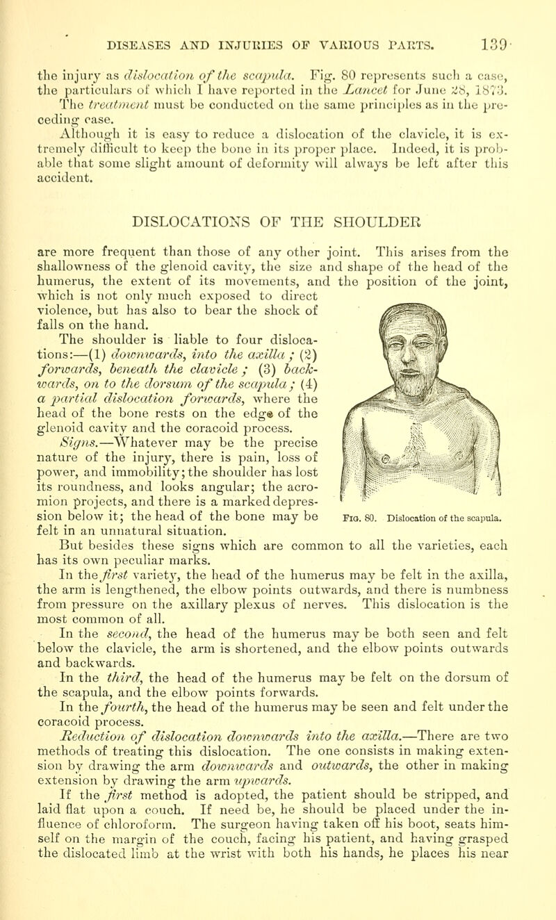 tlie injury as dislocation of the scapula. Fig'. 80 represents sucli a case, tlie particulars of which I have reported in the J^ancet for June 'ffS, 1873. The treat))icnt must be conducted on the same princij)les as in the pre- ceding* case. Although it is easy to reduce a dislocation of the clavicle, it is ex- tremely ditHcult to keep the bone in its proper place. Indeed, it is prob- able that some slight amount of deformity will always be left after this accident. DISLOCATIONS OF THE SHOULDER Pig. 80. Dislocation of the scapula. are more frequent than those of any other joint. This arises from the shallowness of the glenoid cavity, the size and shape of the head of the humerus, the extent of its movements, and the position of the joint, which is not only much exposed to direct violence, but has also to bear the shock of falls on the hand. The shoulder is liable to four disloca- tions:—(1) dowmoards, into the axilla,' (2) forwards, beneath the clavicle ; (3) back- wards, on to the dorsum of the scapida; (4) a partial dislocation forioards, where the head of the bone rests on the edge of the glenoid cavity and the coracoid process. /Signs.—Whatever may be the precise nature of the injury, there is pain, loss of power, and immobility;the shoulder has lost its roundness, and looks angular; the acro- mion projects, and there is a marked depres- sion below it; the head of the bone may be felt in an unnatural situation. But besides these signs which are common to all the varieties, each bas its own peculiar marks. In the f?'st variet}-, the head of the humerus may be felt in the axilla, the arm is lengthened, the elbow points outwards, and there is numbness from pressure on the axillary plexus of nerves. This dislocation is the most common of all. In the second, the head of the humerus may be both seen and felt below the clavicle, the arm is shortened, and the elbow points outwards and backwards. In the third, the head of the humerus may be felt on the dorsum of the scapula, and the elbow points forwards. In the fourth, the head of the humerus may be seen and felt under the coracoid process. deduction of dislocation downtoards into the axilla.—There are two methods of treating this dislocation. The one consists in making exten- sion by drawing the arm dov)mcards and outtoards, the other in making extension by drawing the arm iqnoards. If the first method is adopted, the patient should be stripped, and laid flat upon a couch. If need be, he should be placed under the in- fluence of chloroform. The surgeon having taken off his boot, seats him- self on the margin of the couch, facing his patient, and having grasped the dislocated limb at the wrist with both his hands, he places his near