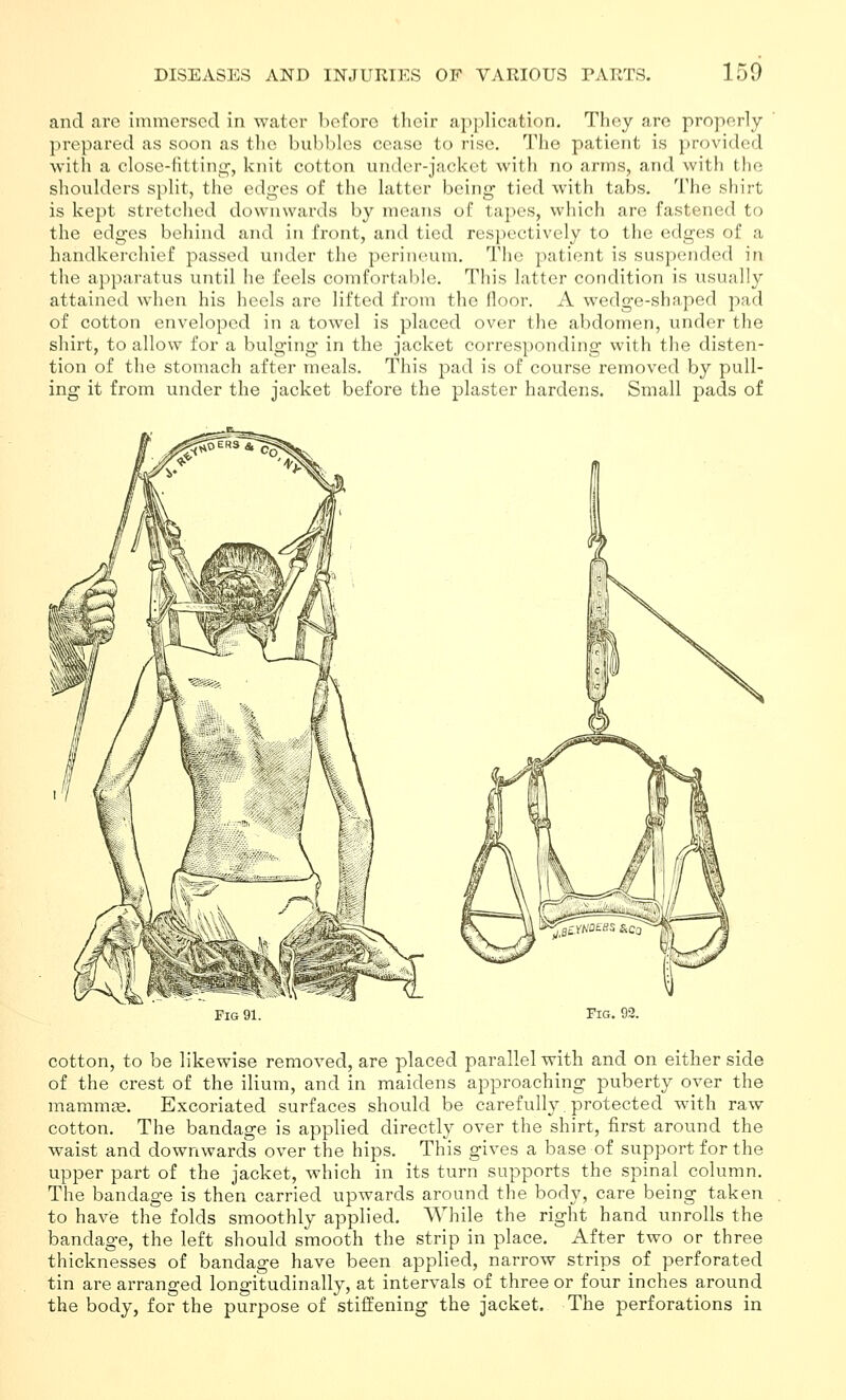 and are immersed in water before their application. Tlicy are properly- prepared as soon as the bubbles cease to rise. The patient is provided with a close-fitting, knit cotton under-jacket with no arms, and with the shoulders split, the edges of the latter being tied with tabs. The shirt is kept stretched downwards by means of tapes, which are fastened to the edges behind and in front, and tied respectively to the edges of a handkerchief passed under the perineum. The patient is suspended in the apparatus until he feels comfortable. This latter condition is usually attained when his heels are lifted from the floor. A wedge-shaped pad of cotton enveloped in a towel is placed over the abdomen, under the shirt, to allow for a bulging in the jacket corresponding with the disten- tion of the stomach after meals. This pad is of course removed by pull- ing it from under the jacket before the plaster hardens. Small pads of Fig 91. Fig. 93. cotton, to be likewise removed, are placed parallel with and on either side of the crest of the ilium, and in maidens approaching puberty over the mammae. Excoriated surfaces should be carefully. protected with raw cotton. The bandage is applied directly over the shirt, first around the waist and downwards over the hips. This gives a base of support for the upper part of the jacket, which in its turn supports the spinal column. The bandage is then carried upwards around the body, care being taken to have the folds smoothly applied. While the right hand unrolls the bandage, the left should smooth the strip in place. After two or three thicknesses of bandage have been applied, narrow strips of perforated tin are arranged longitudinally, at intervals of three or four inches around the body, for the purpose of stiffening the jacket. The perforations in