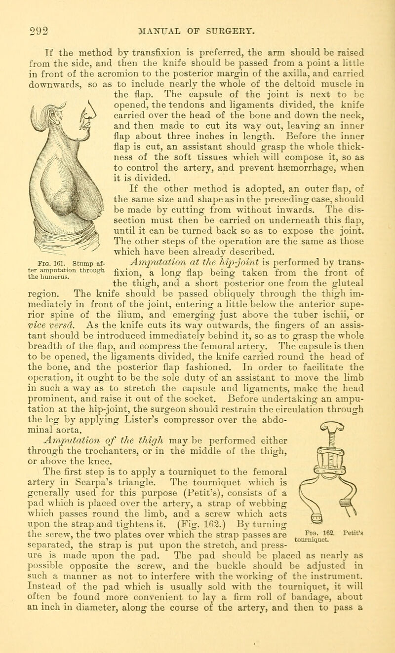 Fig. 161. Stnmp af- ter amputation through the humerus. If the method by transfixion is preferred, the arm should be raised from the side, and then the knife should be passed from a point a little in front of the acromion to the posterior margin of the axilla, and carried downwards, so as to include nearly the whole of the deltoid muscle in the flap. The capsule of the joint is next to be opened, the tendons and ligaments divided, the knife carried over the head of the bone and down the neck, and then made to cut its way out, leaving an inner flap about three inches in length. Before the inner flap is cut, an assistant should grasp the whole thick- ness of the soft tissues which will compose it, so as to control the artery, and prevent haemorrhage, when it is divided. If the other method is adopted, an outer flap, of the same size and shape as in the preceding case, should be made by cutting from without inwards. The dis- section must then be carried on underneath this flap, until it can be turned back so as to expose the joint. The other steps of the operation are the same as those which have been already described. AmjnitatioJi at the hip-joint is performed by trans- fixion, a long flap being taken from the front of the thigh, and a short posteiior one from the gluteal region. The knife should be passed obliquely through the thigh im- mediately in front of the joint, entering a little below the anterior supe- rior spine of the ilium, and emerging just above the tuber ischii, or vice versa. As the knife cuts its way outwards, the fingers of an assis- tant should be introduced immediately behind it, so as to grasp the whole breadth of the flap, and compress the femoral artery. The capsule is then to be opened, the ligaments divided, the knife carried round the head of the bone, and the posterior flap fashioned. In order to facilitate the operation, it ought to be the sole duty of an assistant to move the limb in such a way as to stretch the capsule and ligaments, make the head prominent, and raise it out of the socket. Before undertaking an ampu- tation at the hip-joint, the surgeon should restrain the circulation through the leg by applying Lister's compressor over the abdo- minal aorta. Amputation of the thigh may be performed either through the trochanters, or in the middle of the thigh, or above the knee. The first step is to apply a tourniquet to the femoral artery in Scarpa's triangle. The tourniquet which is generally used for this purpose (Petit's), consists of a pad which is placed over the artery, a strap of webbing which passes round the limb, and a screw which acts upon the strap and tightens it. (Fig. 1G2.) By turning the screw, the two plates over which the strap passes are separated, the strap is put upon the stretch, and press- ure is made upon the pad. The pad should be placed as nearly as possible opposite the screw, and the buckle should be adjusted in such a manner as not to interfere with the working of the instrument. Instead of the pad which is usually sold with the tourniquet, it will often be found more convenient to lay a firm roll of bandage, about an inch in diameter, along the course of the artery, and then to pass a retit's