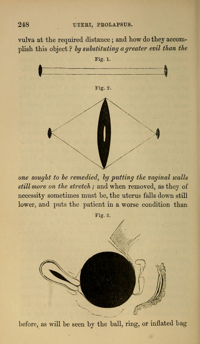 vulva at the required distance ; and how do they accom- plish this object ? ly substituting a greater evil than the Fig. 1. r Fig. 2. one sought to he remedied, hy j^utting the vaginal walls still more on the stretch; and when removed, as they of necessity sometimes must be, the uterus falls down still lower, and puts the patient in a worse condition than Fig. 3. before, as will be seen by the ball, ring, or inflated bag