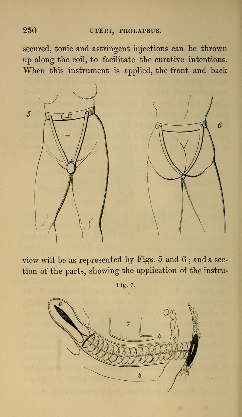 secured, tonic and astringent injections can be thrown up along the coil, to facilitate the curative intentions. When this instrument is applied, the front and back view will be as represented by Figs. 5 and 6 ; and a sec- tion of the parts, showing the application of the instru- Fig. 7.