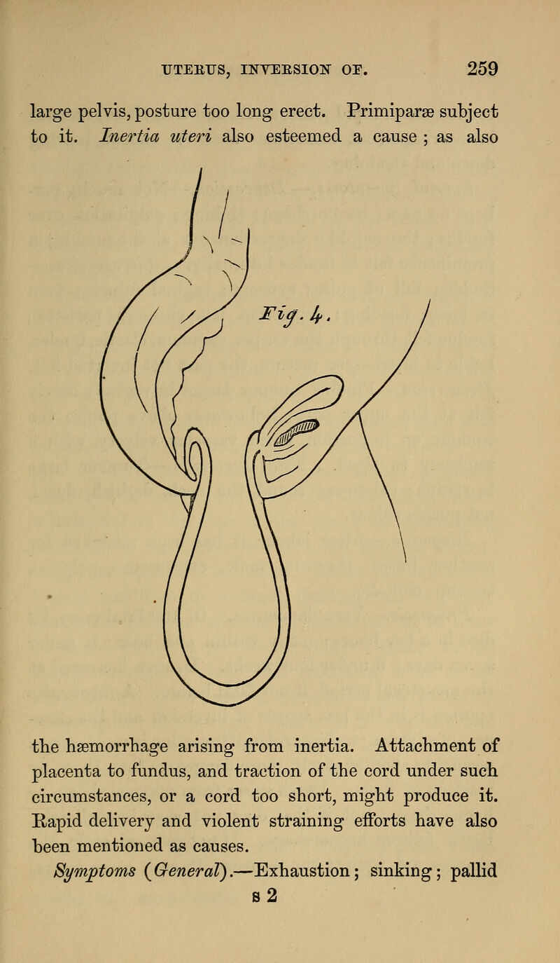 large pelvis, posture too long erect. Primiparse subject to it. Inertia uteri also esteemed a cause ; as also the hsemorrhage arising from inertia. Attachment of placenta to fundus, and traction of the cord under such circumstances, or a cord too short, might produce it. E,apid delivery and violent straining efforts have also been mentioned as causes. Symptoms (^General).—Exhaustion; sinking; pallid s2
