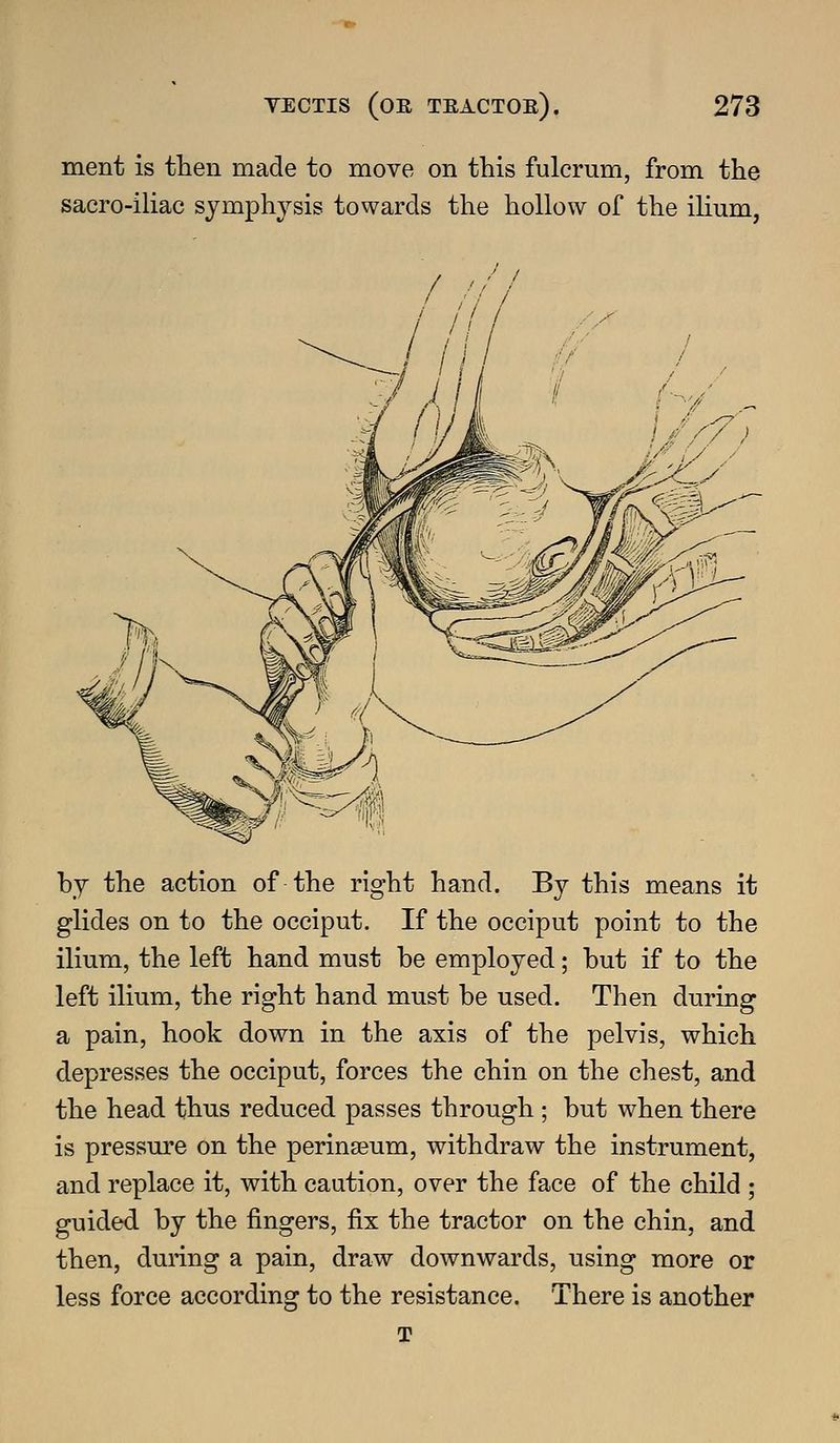 ment is then made to move on this fulcrum, from the sacro-iliac sjmph^'-sis towards the hollow of the ilium, by the action of the right hand. By this means it glides on to the occiput. If the occiput point to the ilium, the left hand must be employed; but if to the left ilium, the right hand must be used. Then diiring a pain, hook down in the axis of the pelvis, which depresses the occiput, forces the chin on the chest, and the head thus reduced passes through ; but when there is pressure on the perinseum, withdraw the instrument, and replace it, with caution, over the face of the child ; guided by the fingers, fix the tractor on the chin, and then, during a pain, draw downwards, using more or There is another T less force according to the resistance.