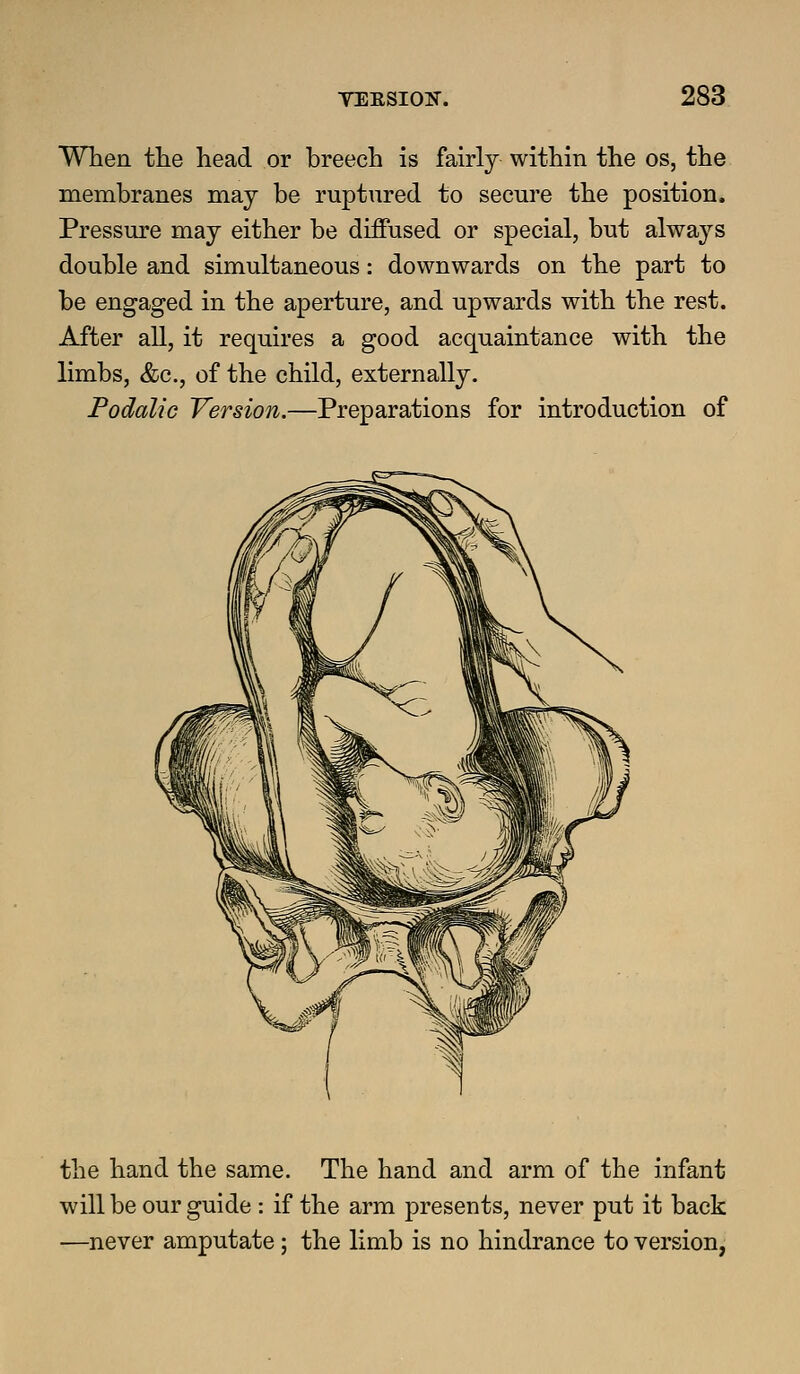 When the head or breech is fairly within the os, the membranes may be ruptured to secure the position. Pressure may either be diffused or special, but always double and simultaneous: downwards on the part to be engaged in the aperture, and upwards with the rest. After all, it requires a good acquaintance with the limbs, &c., of the child, externally. Podalic Version.—Preparations for introduction of the hand the same. The hand and arm of the infant will be our guide : if the arm presents, never put it back —never amputate; the limb is no hindrance to version,