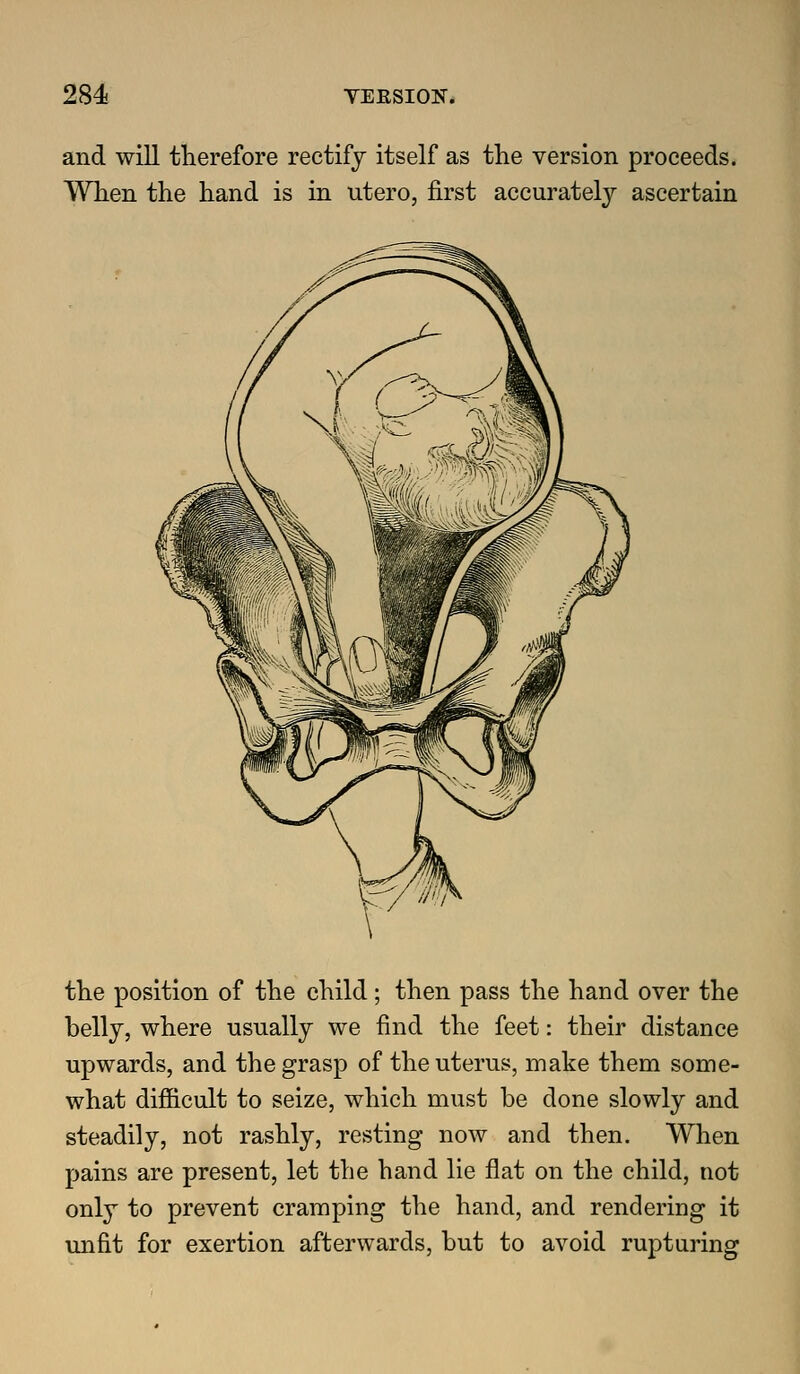 and will therefore rectify itself as the version proceeds. When the hand is in utero, first accurately ascertain the position of the child; then pass the hand over the belly, where usually we find the feet: their distance upwards, and the grasp of the uterus, make them some- what difficult to seize, which must be done slowly and steadily, not rashly, resting now and then. When pains are present, let the hand lie flat on the child, not only to prevent cramping the hand, and rendering it imfit for exertion afterwards, but to avoid rupturing