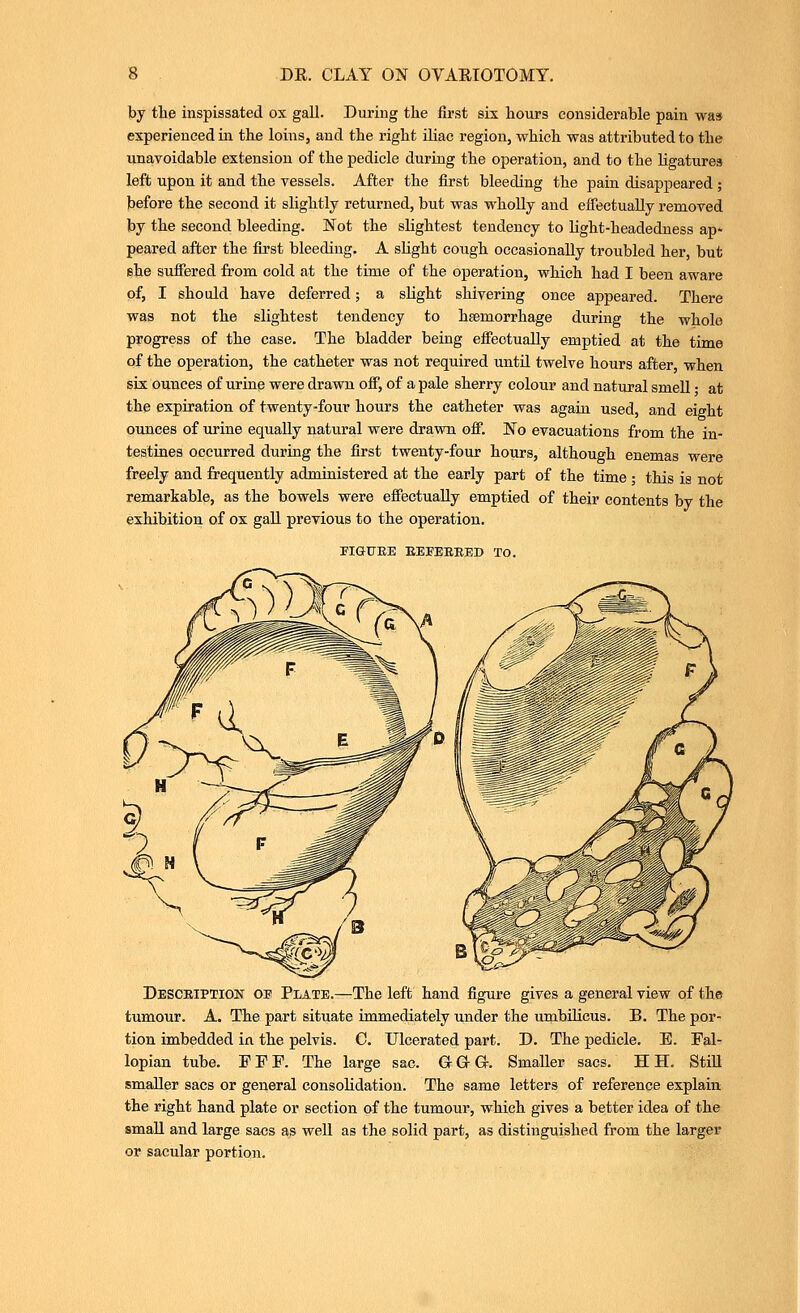 by tlie inspissated ox gall. During the first six hours considerable pain was experienced in the loins, and the right iliac region, which was attributed to the unavoidable extension of the pedicle during the operation, and to the Ligatures left upon it and the vessels. After the first bleeding the pain disappeared ; ]before the second it slightly returned, but was wholly and efiectuaUy removed by the second bleeding. Not the slightest tendency to Light-headedness ap- peared after the first bleeding. A slight cough occasionally troubled her, but ehe sufiered from cold at the time of the operation, which had I been aware of, I should have deferred; a slight shivering once appeared. There was not the slightest tendency to haemorrhage during the whole progress of the case. The bladder being efieotually emptied at the time of the operation, the catheter was not required until twelve hours after when six ounces of urine were drawn oif, of a pale sherry colour and natural smell • at the expiration of twenty-four hours the catheter was again used, and eight ounces of urine equally natural were drawn oif. No evacuations from the in- testines occurred during the first twenty-four hours, although enemas were freely and frequently administered at the early part of the time ; this is not remarkable, as the bowels were effectually emptied of their contents by the exhibition of ox gall previous to the operation. PIGHJEE EEPEEEED TO. DESCEiPa?l0lir of Plate.—The left hand figure gives a general view of the tumour. A. The part situate immediately under the umbilicus. B. The por- tion imbedded in the pelvis. C. Ulcerated part. D. The pedicle. E. Fal- lopian tube. FFF. The large sac. G-G-G. SmaUer sacs, H H. StiU smaller sacs or general consolidation. The same letters of reference explain the right hand plate or section of the tumour, which gives a better idea of the small and large sacs as weU as the solid part, as distinguished from the larger or sacular portion.