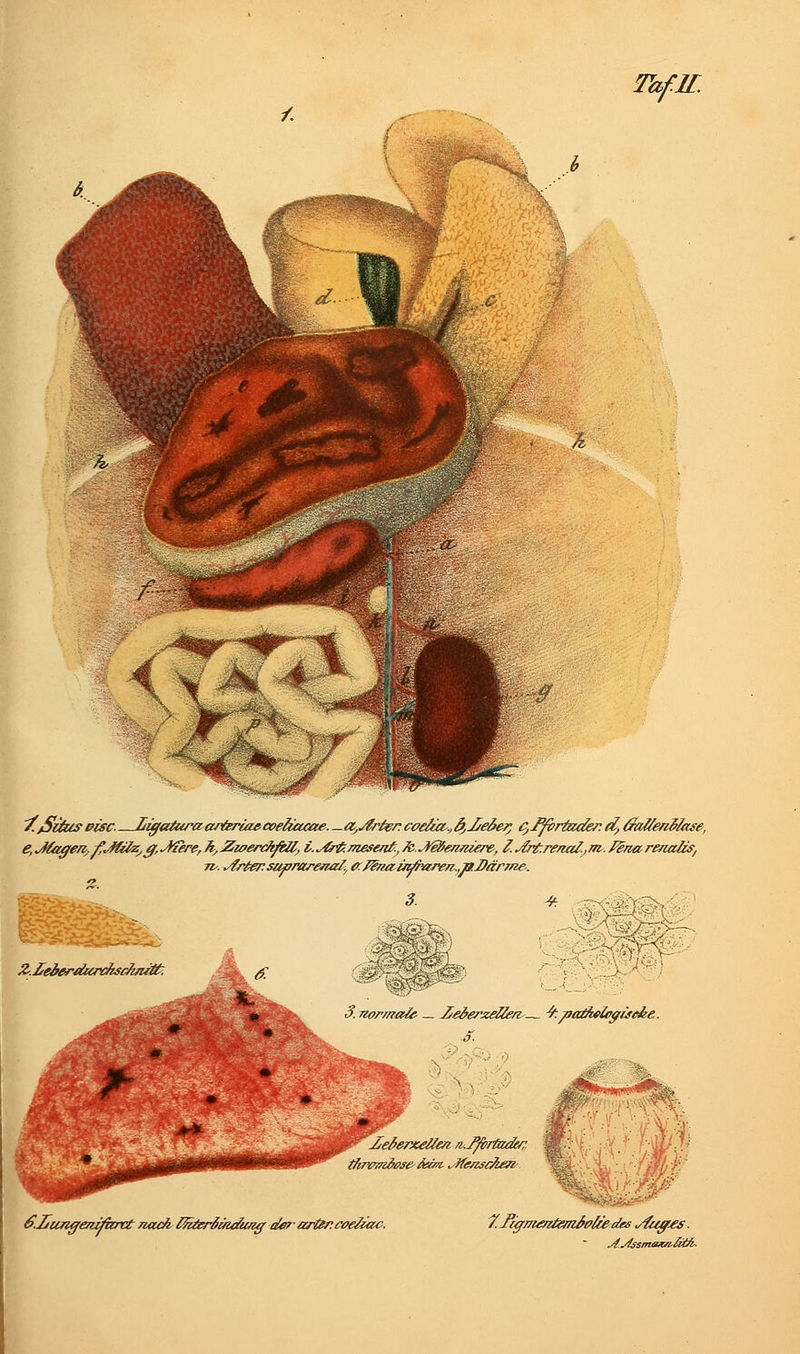 A '/.^Siä/s Pisa LiffeUuraariereste coeltacae. _ a,jirter. coeäa-^ &,Jjeäej) c, Ifbrtader d, Gallenblase, e, Jlofferi'^f.J&lZyff, .liiere, h, Zze/erckfill^ i. ./fyti/TiesenA, Ic. J^erniiere-, l. .^Tdrenal.) m-. fSrui^ renaliSj Tt'. ^r/^r su^raremz/y {k l^na.ii^Yiren,.,n2fär7ne. Z.ieieriiurc^clmM^. ■^-j n^)^':':-:-^: 3. Tiormale- _ Zei^erxe^n.— '9: ^a^le^ise&e. 6.ZunffenMatt /iock l^ä^ömc&ißff tiefizrier.coeliac. 7Ti^nieniemialce^des ylu^^s J/e^erxellei7 /^ J'/^rtide/ ji.^smax/i-^^^