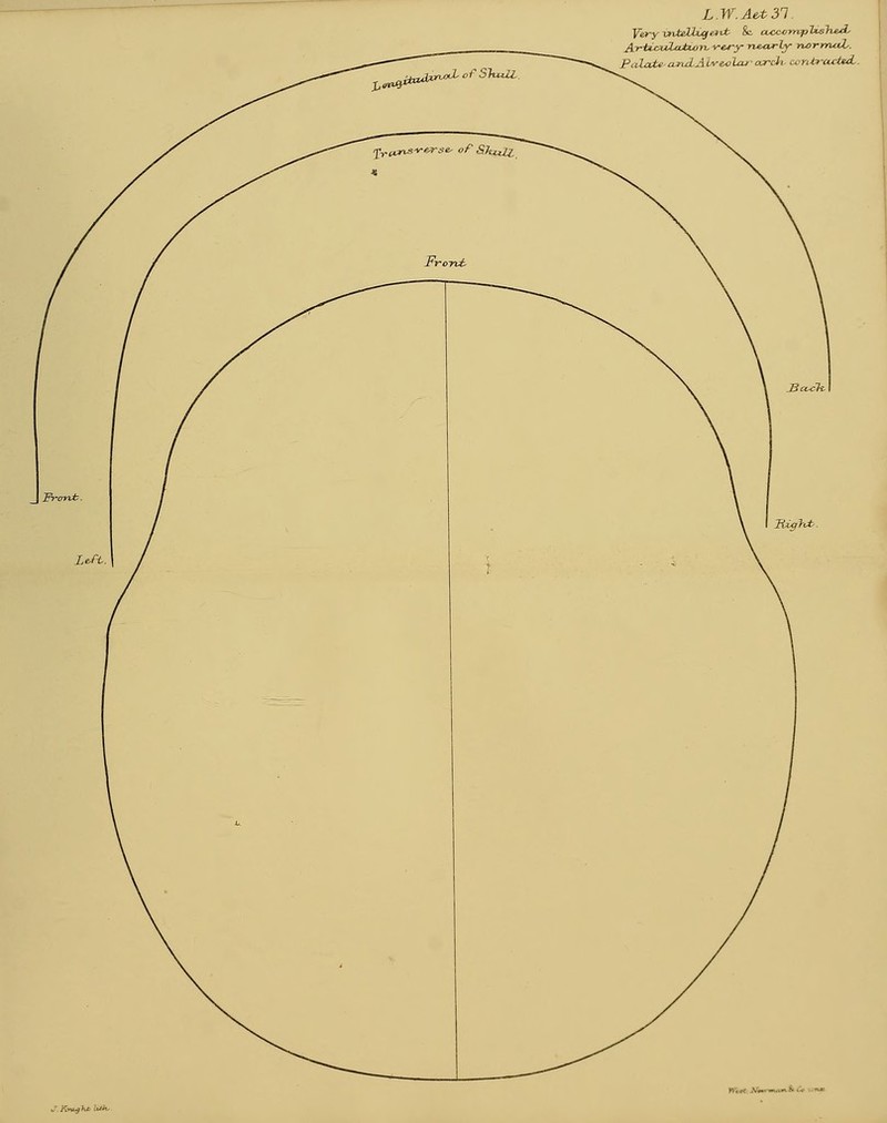 LW.Ae.t31 YeryvrUMCgexvt &. cucccmpUsTieA- Artu^latuii^vefy nearly normal-. Palate- and A Lv&olar arcli ccntf-axted,.
