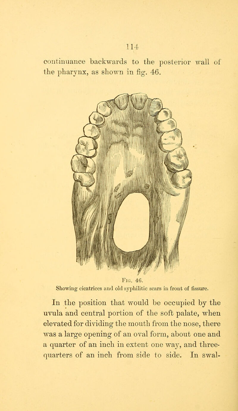 continuance backwards to the posterior wall of the pharynx, as shown in fig. 46. Fig. 46. Showing cicatrices and old syphilitic scars in front of fissure. In the position that would be occupied by the uvula and central portion of the soft palate, when elevated for dividing the mouth from the nose, there was a large opening of an oval form, about one and a quarter of an inch in extent one way, and three- quarters of an inch from side to side. In swal-