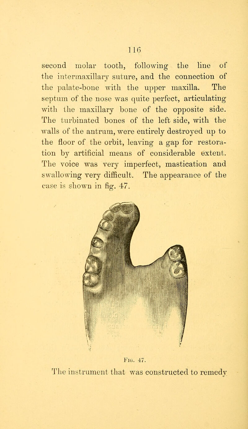 second molar tooth, following tlie line of the intermaxillary suture, and the connection of the palate-bone with the upper maxilla. The septum of the nose was quite perfect, articulating with the maxillary bone of the opposite side. The turbinated bones of the left side, with the walls of the antrum, were entirely destroyed up to the floor of the orbit, leaving a gap for restora- tion by artificial means of considerable extent. The voice was very imperfect, mastication and swallowing very difficult. The appearance of the case is shown in fig. 47. Fig. 47. The instrument that was constructed to remedy