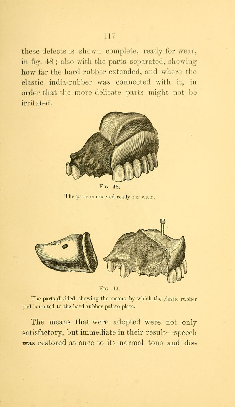 1 17 these defects is shown complete, ready for wear, iu fig. 48 ; also with the parts separated, showing how far the hard rubber extended, and where the elastic india-rubber was connected with it, in order that the more delicate parts might not be irritated. Fig. 48. The parts connected ready for wear. Fig. F.i. The parts divided showing the means by which the elastic rubber pad is united to the hard rubber palate pkte. The means that were adopted were not only satisfactory, but immediate in their result—speech was restored at once to its normal tone and dis-