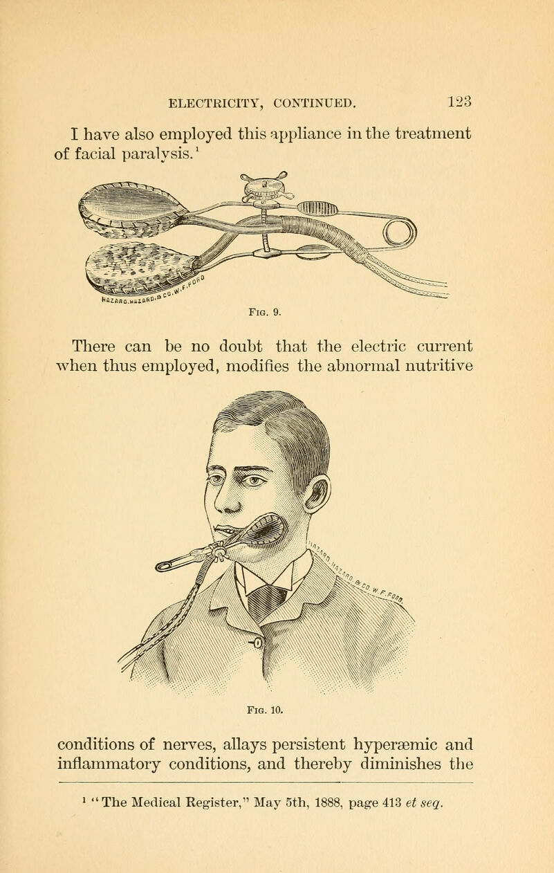 ELECTRICITY, CONTINUED. I have also employed this appliance in the treatment of facial paralysis.' Fig. 9. There can be no doubt that the electric current when thus employed, modifies the abnormal nutritive Fig. 10. conditions of nerves, allays persistent hypersemic and inflammatory conditions, and thereby diminishes the »  The Medical Register, May 5th, 1888, page 413 et seq.