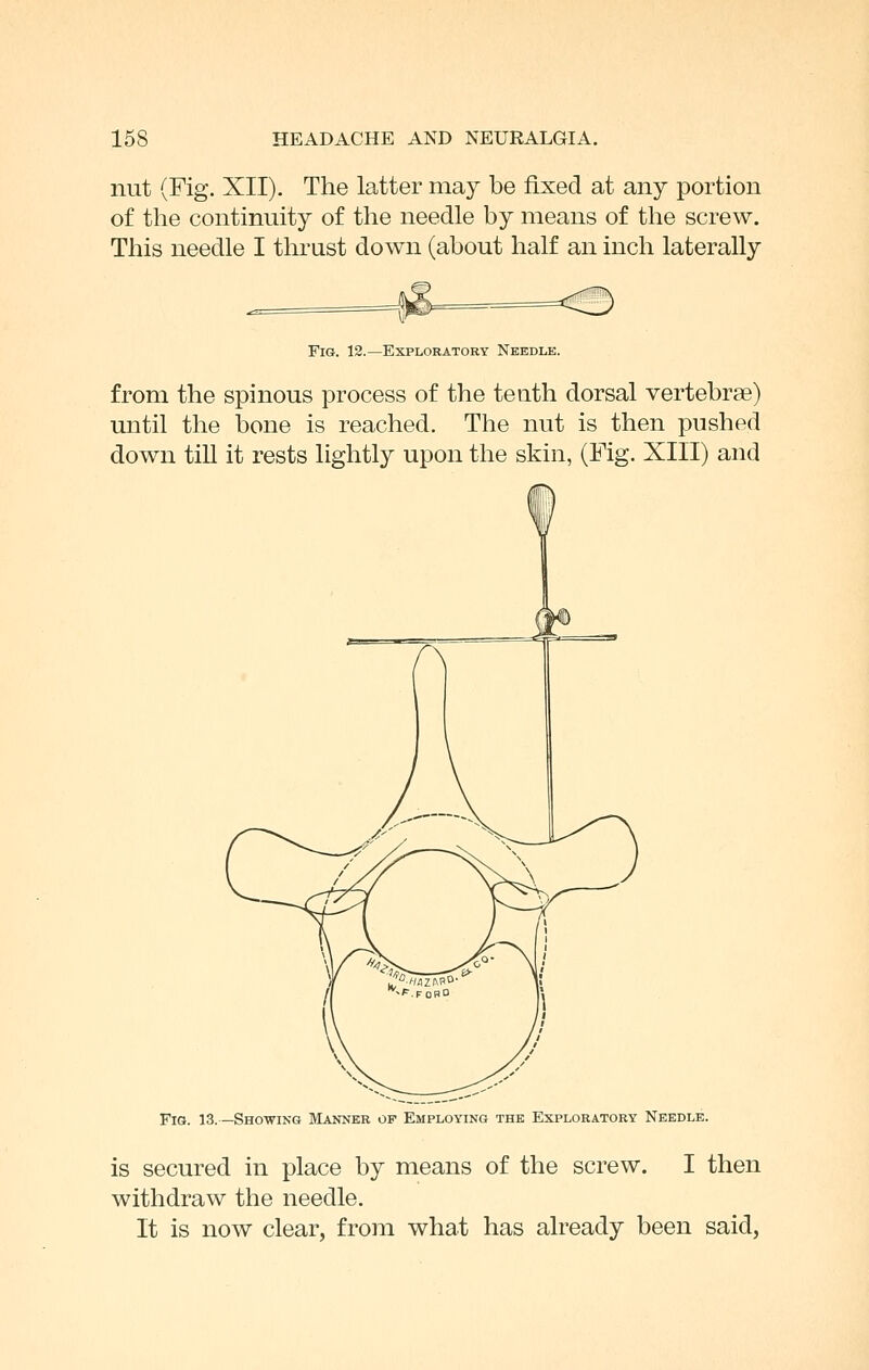 nut (Fig. XII). The latter may be fixed at any portion of the continuity of the needle by means of the screw. This needle I thrust down (about half an inch laterally Fig. 12.—Exploratory Needle. from the spinous process of the tenth dorsal vertebrae) until the l3one is reached. The nut is then pushed down till it rests lightly upon the skin, (Fig. XIII) and Fig. 13.—Showing Manner op Employing the Exploratory Needle. is secured in place by means of the screw. I then withdraw the needle. It is now clear, from what has already been said,