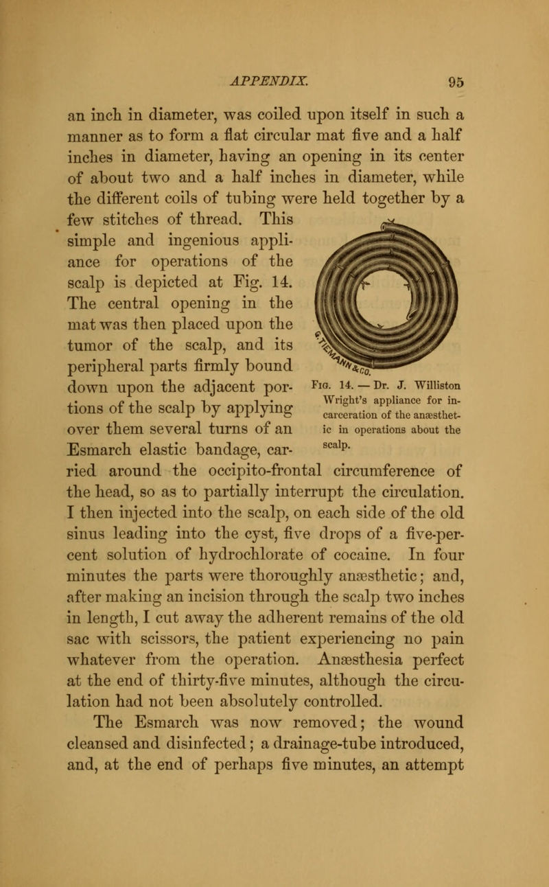 an incli in diameter, was coiled upon itself in such a manner as to form a flat circular mat five and a lialf inches in diameter, having an opening in its center of about two and a half inches in diameter, while the different coils of tubing were held together by a few stitches of thread. This simple and ingenious appli- ance for operations of the scalp is depicted at Fig. 14. The central opening in the mat was then placed upon the tumor of the scalp, and its peripheral parts firmly bound ^^^ down upon the adjacent por- Fig. u. — Dr. j. wniiston ,. /» , 1 IT 1 • Wright's appliance for in- tions of the scalp by applying earcLtion of the an^sthet- over them several turns of an ic in operations about the Esmarch elastic bandage, car- ^^^^p* ried around the occipito-frontal circumference of the head, so as to partially interrupt the circulation. I then injected into the scalp, on each side of the old sinus leading into the cyst, five drops of a five-per- cent solution of hydrochlorate of cocaine. In four minutes the parts were thoroughly anaesthetic; and, after making an incision through the scalp two inches in length, I cut away the adherent remains of the old sac with scissors, the patient experiencing no pain whatever from the operation. Anaesthesia perfect at the end of thirty-five minutes, although the circu- lation had not been absolutely controlled. The Esmarch was now removed; the wound cleansed and disinfected; a drainage-tube introduced, and, at the end of perhaps five minutes, an attempt