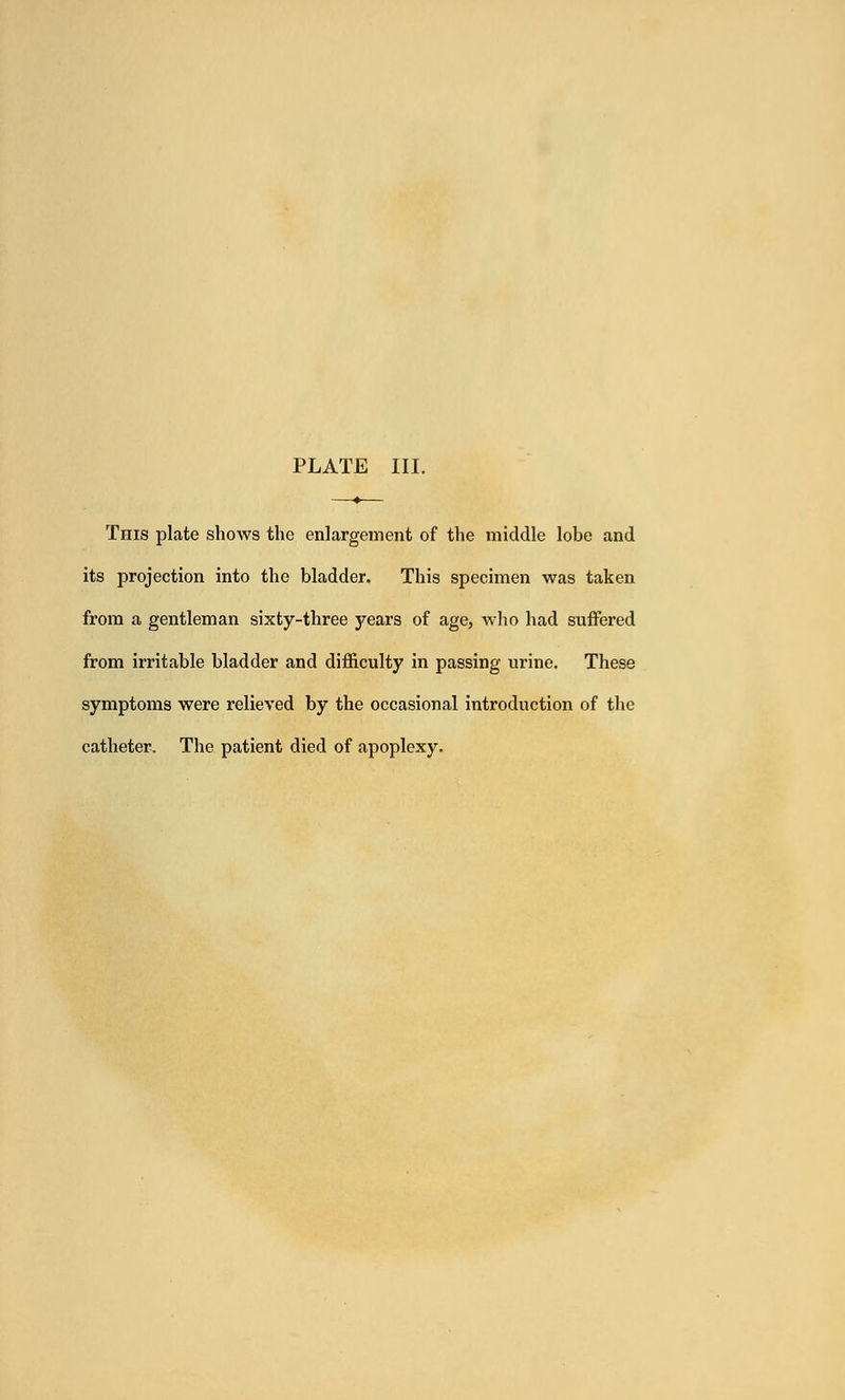 This plate shows the enlargement of the middle lobe and its projection into the bladder. This specimen was taken from a gentleman sixty-three j^ears of age, who had suffered from irritable bladder and difficulty in passing urine. These symptoms were relieved by the occasional introduction of the catheter. The patient died of apoplexy.