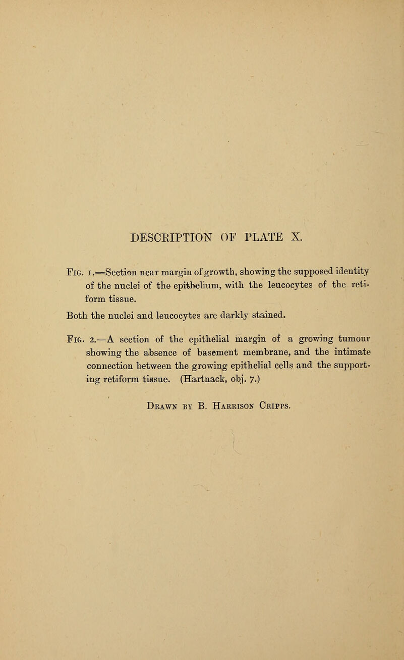 Fig. i.—Section near margin of growth, showing the supposed identity of the nuclei of the epithelium, with the leucocytes of the reti- form tissue. Both the nuclei and leucocytes are darkly stained. Fig. 2.—A section of the epithelial margin of a growing tumour showing the absence of basement membrane, and the intimate connection between the growing epithelial cells and the support- ing retiform tissue. (Hartnack, obj. 7.)