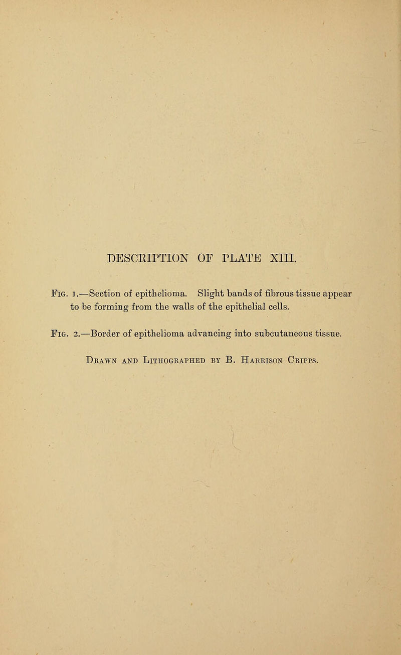 Fig. i.—Section of epithelioma. Slight bands of fibrous tissue appear to be formiug from the walls of the epithelial cells. Fig. 2.—Border of epithelioma advancing into subcutaneous tissue. Drawn and Lithographed by B. Harrison Cripps.