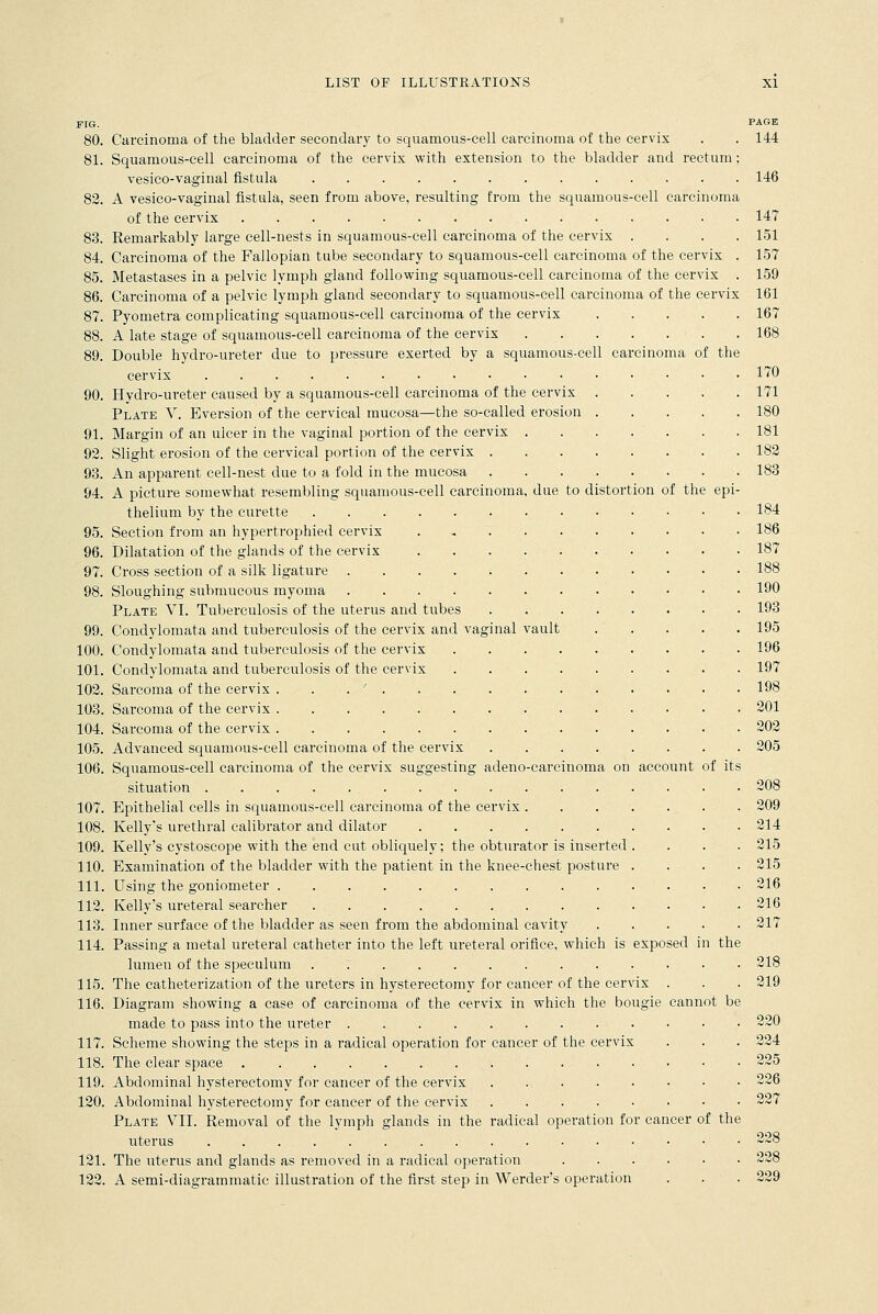 PAGE FIG. 80. Carcinoma of the bladder secondary to squamous-cell carcinoma of the cervix . . 144 81. Squamous-cell carcinoma of the cervix with extension to the bladder and rectum; vesico-vaginal fistula 146 82. A vesico-vaginal fistula, seen from above, resulting from the squamous-cell carcinoma of the cervix 147 83. Remarkably large cell-nests in squamous-cell carcinoma of the cervix .... 151 84. Carcinoma of the Fallopian tube secondary to squamous-cell carcinoma of the cervix . 157 85. Metastases in a pelvic lymph gland following squamous-cell carcinoma of the cervix . 159 86. Carcinoma of a pelvic lymph gland secondary to squamous-cell carcinoma of the cervix 161 87. Pyometra complicating squamous-cell carcinoma of the cervix 167 88. A late stage of squamous-cell carcinoma of the cervix 168 89. Double hydro-ureter due to pressure exerted by a squamous-cell carcinoma of the cervix .........•■•■••• 170 90. Hydro-ureter caused by a squamous-cell carcinoma of the cervix 171 Plate V. Eversion of the cervical mucosa—the so-called erosion 180 91. Margin of an ulcer in the vaginal portion of the cervix 181 92. Slight erosion of the cervical portion of the cervix 182 93. An apparent cell-nest due to a fold in the mucosa 183 94. A picture somewhat resembling squamous-cell carcinoma, due to distortion of the epi- thelium by the curette 184 95. Section from an hypertrophied cervix 186 96. Dilatation of the glands of the cervix . 187 97. Cross section of a silk ligature 188 98. Sloughing submucous myoma 190 Plate VI. Tuberculosis of the uterus and tubes 193 99. Condylomata and tuberculosis of the cervix and vaginal vault 195 100. Condylomata and tuberculosis of the cervix 196 101. Condylomata and tuberculosis of the cervix 197 102. Sarcoma of the cervix . ' 198 103. Sarcoma of the cervix . 201 104. Sarcoma of the cervix 202 105. Advanced squamous-cell carcinoma of the cervix 205 106. Squamous-cell carcinoma of the cervix suggesting adeno-carcinoma on account of its situation 208 107. Epithelial cells in squamous-cell carcinoma of the cervix 209 108. Kelly's urethral calibrator and dilator 214 109. Kelly's cystoscope with the end cut obliquely; the obturator is inserted .... 215 110. Examination of the bladder with the patient in the knee-chest posture . . . . 215 111. Using the goniometer 216 112. Kelly's ureteral searcher 216 113. Inner surface of the bladder as seen from the abdominal cavity 217 114. Passing a metal ureteral catheter into the left ureteral orifice, which is exposed in the lumen of the speculum 218 115. The catheterization of the ureters in hysterectomy for cancer of the cervix . . . 219 116. Diagram showing a case of carcinoma of the cervix in which the bougie cannot be made to pass into the ureter 220 117. Scheme showing the steps in a radical operation for cancer of the cervix . . . 224 118. The clear space 225 119. Abdominal hysterectomy for cancer of the cervix 226 120. Abdominal hysterectomy for cancer of the cervix 227 Plate VII. Removal of the lymph glands in the radical operation for cancer of the uterus 228 121. The uterus and glands as removed in a radical operation 228 122. A semi-diagrammatic illustration of the first step in Werder's operation . . . 229
