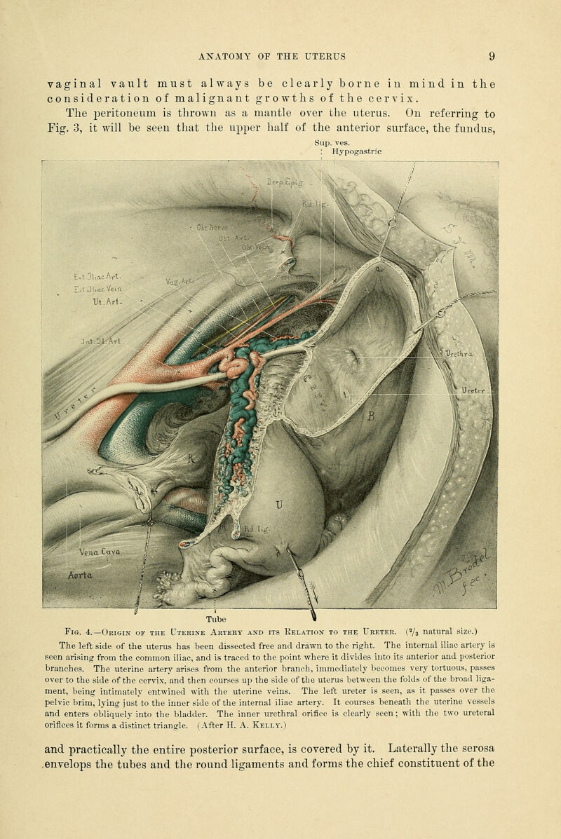 vaginal vault must always be clearly borne in mind in the consideration of malignant growths of the cervix. The peritoneum is thrown as a mantle over the uterus. On referring to Fig. 3, it will be seen that the upper half of the anterior surface, the fundus, Sup. ves. : Hypogastric Tube Fig. 4.—Origin of the Uterine Artery and its Relation to the Ureter. (2/3 natural size.) The left side of the uterus has been dissected free and drawn to the right. The internal iliac artery is seen arising from the common iliac, and is traced to the point where it divides into its anterior and posterior branches. The uterine artery arises from the anterior branch, immediately becomes very tortuous, passes over to the side of the cervix, and then courses up the side of the uterus between the folds of the broad liga- ment, being intimately entwined with the uterine veins. The left ureter is seen, as it passes over the pelvic brim, lying just to the inner side of the internal iliac artery. It courses beneath the uterine vessels and enters obliquely into the bladder. The inner urethral orifice is clearly seen; with the two ureteral orifices it forms a distinct triangle. (After H. A. Kelly.) and practically the entire posterior surface, is covered by it. Laterally the serosa envelops the tubes and the round ligaments and forms the chief constituent of the