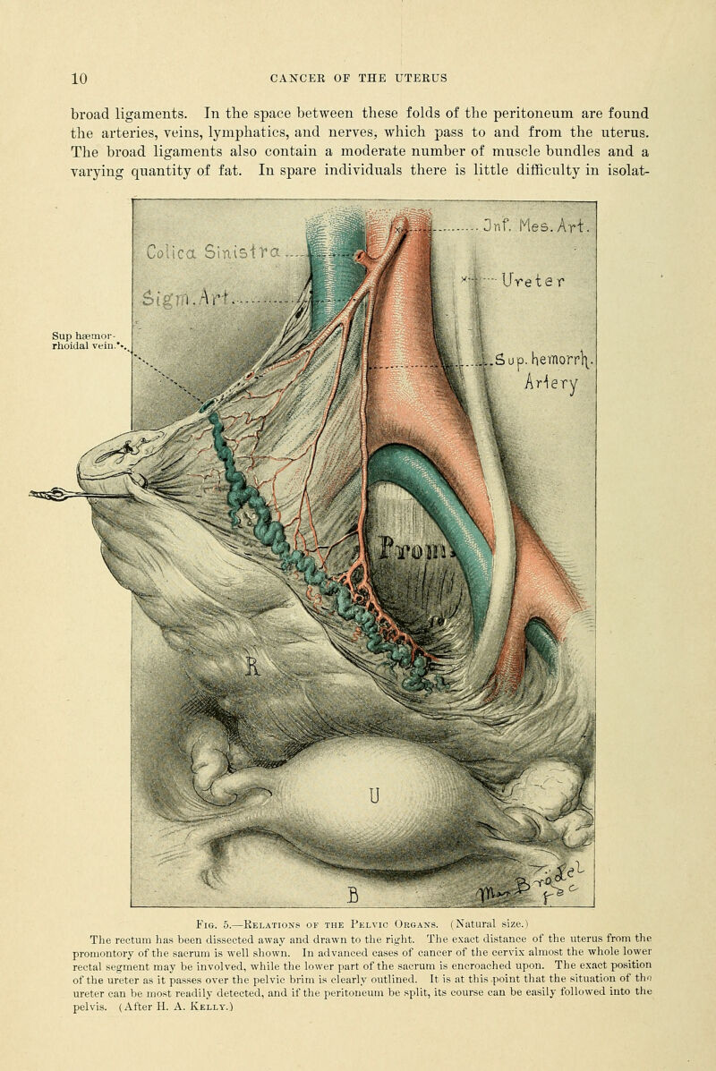 broad ligaments. In the space between these folds of the peritoneum are found the arteries, veins, lymphatics, and nerves, which pass to and from the uterus. The broad ligaments also contain a moderate number of muscle bundles and a varying quantity of fat. In spare individuals there is little difficulty in isolat- Sup hsemor- rhoidal vein.* Onf. Mes.Art. ••- Ureter LSup. hemorrlv Artery '^'W ,1.1 ;// R ??##&■ u Fig. 5.—Relations of the Pelvic Organs. (Natural size.) The rectum has been dissected away and drawn to the right. The exact distance of the uterus from the promontory of the sacrum is well shown. In advanced cases of cancer of the cervix almost the whole lower rectal segment may be involved, while the lower part of the sacrum is encroached upon. The exact position of the ureter as it passes over the pelvic brim is clearly outlined. It is at this point that the situation of tho ureter can be most readily detected, and if the peritoneum be split, its course can be easily followed into the pelvis. (After H. A. Kelly.)