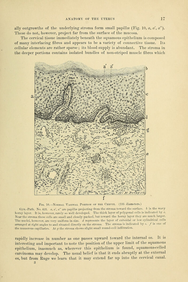 ally outgrowths of the underlying stroma form small papillae (Fig. 10, «, a', a). These do not, however, project far from the surface of the mucosa. The cervical tissue immediately beneath the squamous epithelium is composed of many interlacing fibres and appears to be a variety of connective tissue. Its cellular elements are rather sparse ; its blood supply is abundant. The stroma in the deeper portions contains isolated bundles of non-striped muscle fibres which © & o ° 'u ->, a Ox S -/k ^©i _ -i^ O -01 fegiai ^C Fig. 10.—Normal Vaginal Portion of the Cervix. (135 diameters.) Gyn.-Path. No. 423. a, a\ a are papilla? projecting from the stroma toward the surface, b is the -wavy- horny layer. It is, however, rarely so well developed. The thick layer of polygonal cells is indicated by c. Near the stroma these cells are small and closely packed, but toward the horny layer they are much larger. The nuclei, however, are very uniform in size, d represents the layer of cuboidal or low cylindrical cells arranged at right angles to and situated directly on the stroma. The stroma is indicated by e. f is one of the numerous capillaries. At g the stroma shows slight small round-cell infiltration. rapidly increase in number as one passes upward toward the internal os. It is interesting and important to note the position of the upper limit of the squamous epithelium, inasmuch as, wherever this epithelium is found, squamous-celled carcinoma may develop. The usual belief is that it ends abruptly at the external os, but from Huge we learn that it may extend far up into the cervical canal.