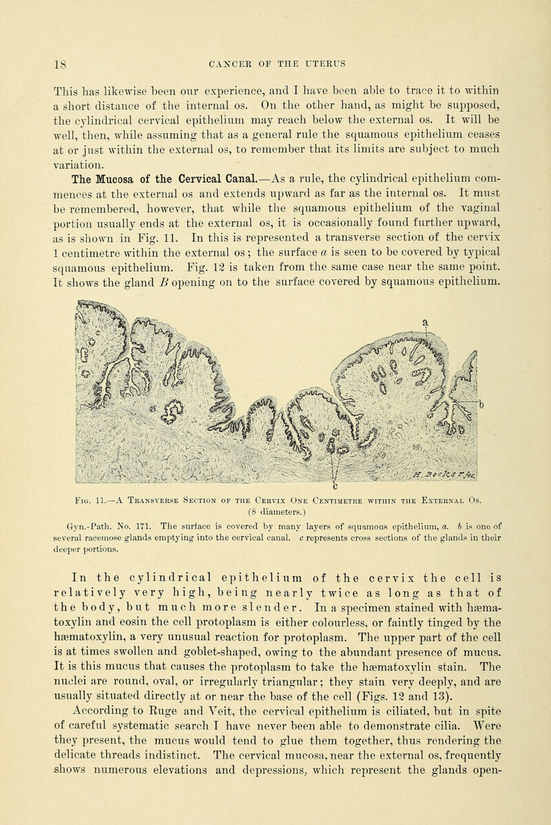 This lias likewise been our experience, and I have been able to trace it to within a short distance of the internal os. On the other hand, as might be supposed, the cylindrical cervical epithelium may reach below the external os. It will be well, then, while assuming that as a general rule the squamous epithelium ceases at or just within the external os, to remember that its limits are subject to much variation. The Mucosa of the Cervical Canal.—As a rule, the cylindrical epithelium com- mences at the external os and extends upward as far as the internal os. It must be remembered, however, that while the squamous epithelium of the vaginal portion usually ends at the external os, it is occasionally found further upward, as is shown in Fig. 11. In this is represented a transverse section of the cervix 1 centimetre within the external os ; the surface a is seen to be covered by typical squamous epithelium. Fig. 12 is taken from the same case near the same point. It shows the gland B opening on to the surface covered by squamous epithelium. m ■, ^r.JT.-SecJce'r./ecJ Fig. 11.—A Transverse Section; of the Cervix One Centimetre within the External Os. (8 diameters.) Gyn.-Path. No. 171. The surface is covered by many layers of squamous epithelium, a. b is one of several racemose glands emptying into the cervical canal, c represents cross sections of the glands in their deeper portions. In the cylindrical epithelium of the cervix the cell is relatively very high, being nearly twice as long as that of the body, but much more slender. In a specimen stained with hsema- toxylin and eosin the cell protoplasm is either colourless, or faintly tinged by the hgematoxylin, a very unusual reaction for protoplasm. The upper part of the cell is at times swollen and goblet-shaped, owing to the abundant presence of mucus. It is this mucus that causes the protoplasm to take the hgematoxylin stain. The nuclei are round, oval, or irregularly triangular; they stain very deeply, and are usually situated directly at or near the base of the cell (Figs. 12 and 13). According to Euge and Veit, the cervical epithelium is ciliated, but in spite of careful systematic search I have never been able to demonstrate cilia. Were they present, the mucus would tend to glue them together, thus rendering the delicate threads indistinct. The cervical mucosa, near the external os, frequently shows numerous elevations and depressions, which represent the glands open-