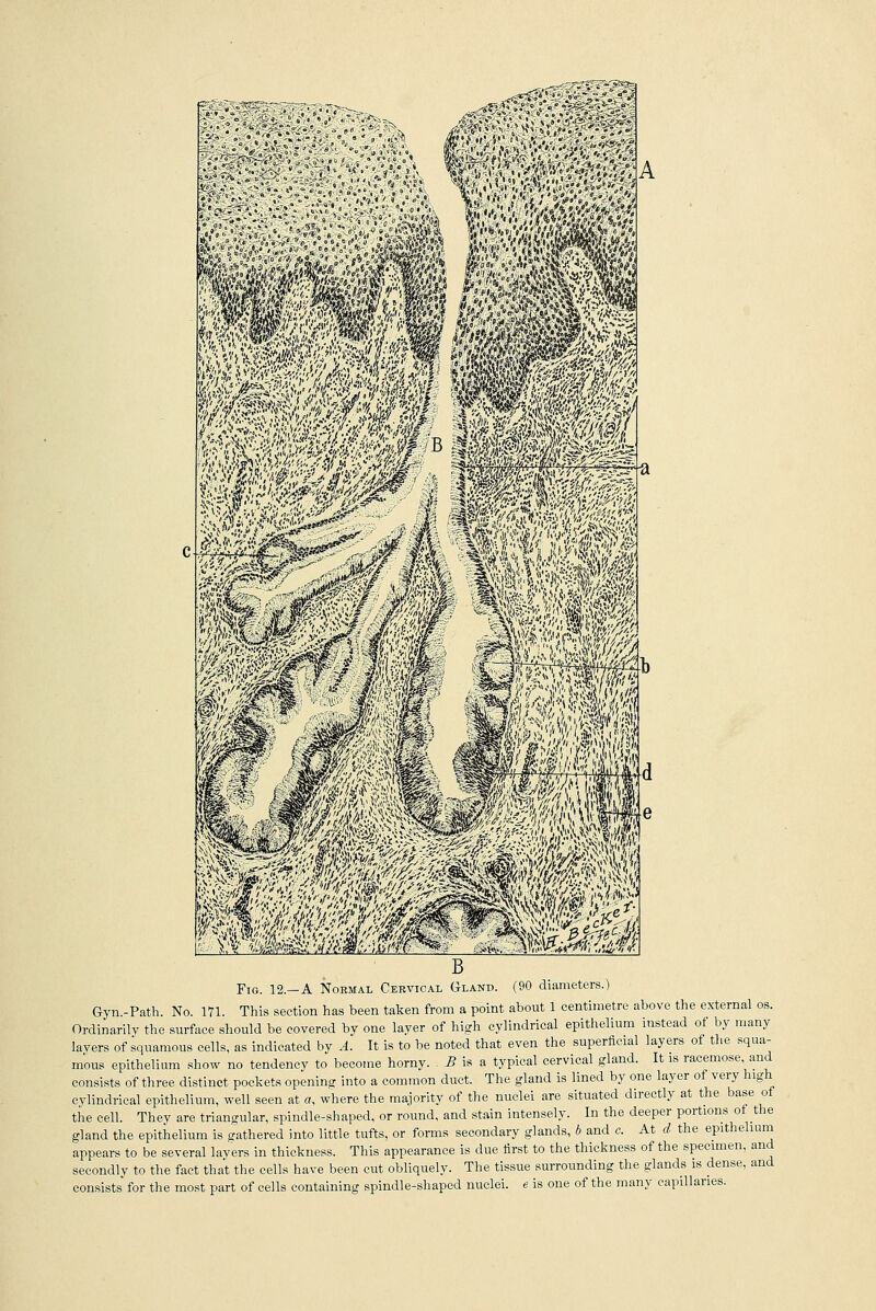 A >?'.$£• Fig. 12.—A Normal Cervical Gland. (90 diameters.) Gyn.-Path. No. 171. This section has been taken from a point about 1 centimetre above the external os. Ordinarily the surface should be covered by one layer of high cylindrical epithelium instead of by many layers of squamous cells, as indicated by A. It is to be noted that even the superficial layers of the squa- mous epithelium show no tendency to become horny. B is a typical cervical gland. It is racemose and consists of three distinct pockets opening into a common duct. The gland is lined by one layer of very high cylindrical epithelium, well seen at a, where the majority of the nuclei are situated directly at the base of the cell. They are triangular, spindle-shaped, or round, and stain intensely. In the deeper portions of the gland the epithelium is gathered into little tufts, or forms secondary glands, b and c. At d the epithelium appears to be several layers in thickness. This appearance is due first to the thickness of the specimen, and secondly to the fact that the cells have been cut obliquely. The tissue surrounding the glands is dense, and consists for the most part of cells containing spindle-shaped nuclei, e is one of the many capillaries.