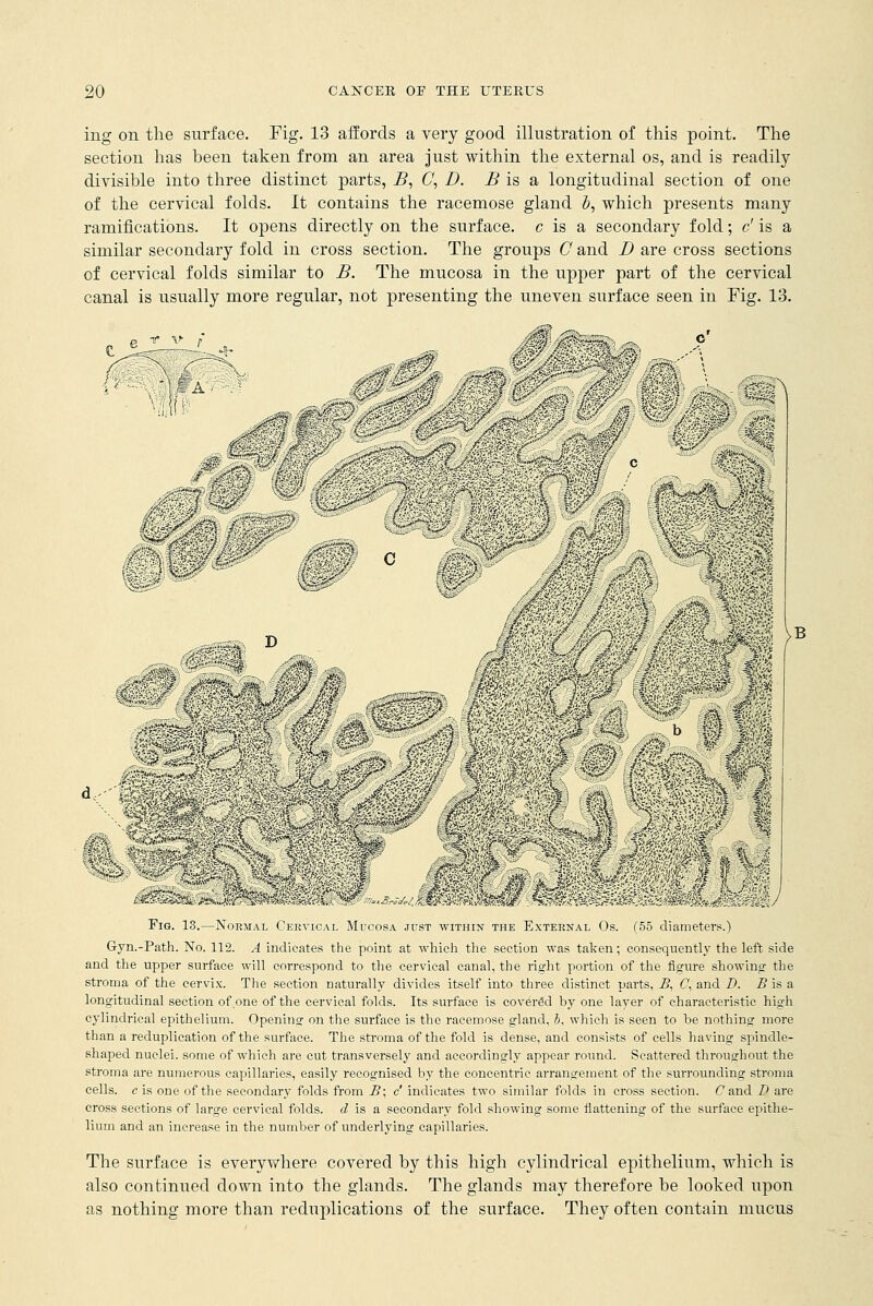 ing on the surface. Fig. 13 affords a very good illustration of this point. The section has been taken from an area just within the external os, and is readily divisible into three distinct parts, B, C, D. B is a longitudinal section of one of the cervical folds. It contains the racemose gland b, which presents many ramifications. It opens directly on the surface, c is a secondary fold; c' is a similar secondary fold in cross section. The groups C and D are cross sections of cervical folds similar to B. The mucosa in the upper part of the cervical canal is usually more regular, not presenting the uneven surface seen in Fig. 13. Fig. 13.—Normal Cervical Mucosa just within the External Os. (55 diameters.) Gyn.-Path. No. 112. A indicates the point at which the section was taken; consequently the left side and the upper surface will correspond to the cervical canal, the right portion of the figure showing the stroma of the cervix. The section naturally divides itself into three distinct parts, B, C, and D. B is a longitudinal section of one of the cervical folds. Its surface is covered by one layer of characteristic high cylindrical epithelium. Opening on the surface is the racemose gland, 5, which is seen to he nothing more than a reduplication of the surface. The stroma of the fold is dense, and consists of cells having spindle- shaped nuclei, some of which are cut transversely and accordingly appear round. Scattered throughout the stroma are numerous capillaries, easily recognised by the concentric arrangement of the surrounding stroma cells, c is one of the secondary folds from B; c' indicates two similar folds in cross section. Cand D are cross sections of large cervical folds, d is a secondary fold showing some flattening of the surface epithe- lium and an increase in the number of underlying capillaries. The surface is everywhere covered by this high cylindrical epithelium, which is also continued down into the glands. The glands may therefore be looked upon as nothing more than reduplications of the surface. They often contain mucus