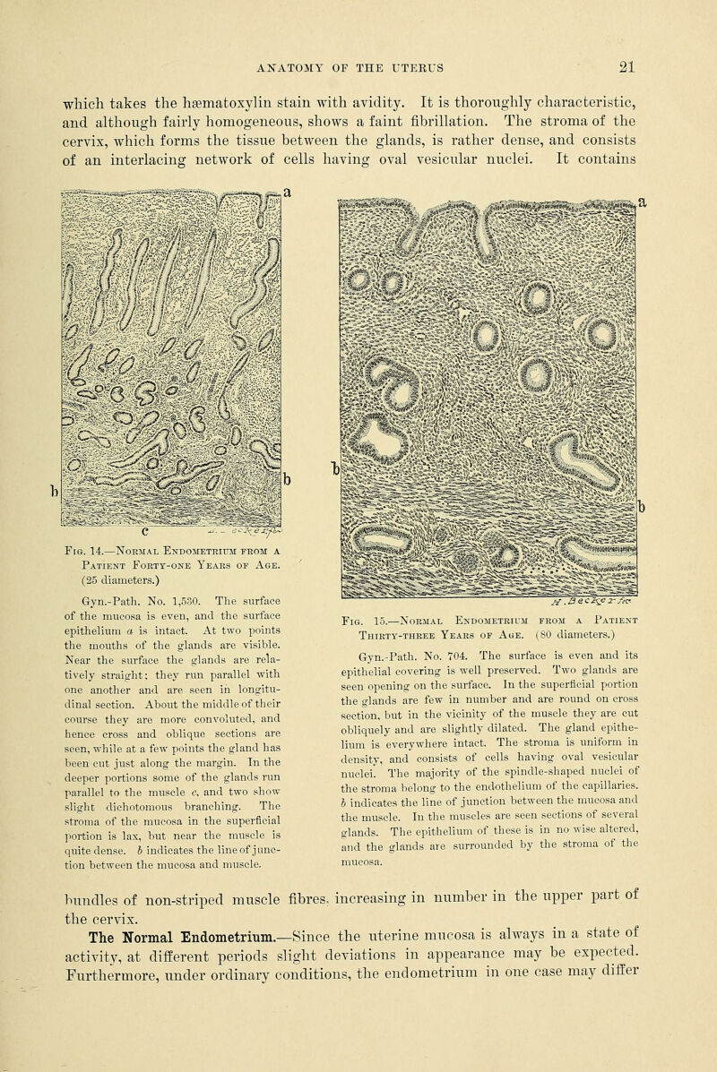 which takes the liEematoxylin stain with avidity. It is thoroughly characteristic, and although fairly homogeneous, shows a faint fibrillation. The stroma of the cervix, which forms the tissue between the glands, is rather dense, and consists of an interlacing network of cells having oval vesicular nuclei. It contains Fig. 14.—Normal Endometrium from a Patient Forty-one Years of Age. (25 diameters.) Gyn.-Path. No. 1,530. The surface of the mucosa, is even, and the surface epithelium a is intact. At two points the mouths of the glands are visible. Near the surface the glands are rela- tively straight; they run parallel with one another and are seen in longitu- dinal section. About the middle of their course they are more convoluted, and hence cross and oblique sections are seen, while at a few points the gland has been cut just along the margin. In the deeper portions some of the glands run parallel to the muscle c, and two show slight dichotomous branching. The stroma of the mucosa in the superficial portion is lax, but near the muscle is quite dense, b indicates the line of junc- tion between the mucosa and muscle. ff ,B6Ci<^ Jrfecr- Fig. 15.—Normal Endometrium from a Fatient Thirty-three Years of Age. (80 diameters.) Gyn.-Path. No. 704. The surface is even and its epithelial covering is well preserved. Two glands are seen opening on the surface. In the superficial portion the glands are few in number and are round on cross section, but in the vicinity of the muscle they are cut obliquely and are slightly dilated. The gland epithe- lium is everywhere intact. The stroma is uniform in density, and consists of cells having oval vesicular nuclei. The majority of the spindle-shaped nuclei of the stroma belong to the endothelium of the capillaries. I indicates the line of junction between the mucosa and the muscle. In the muscles are seen sections of several glands. The epithelium of these is in no wise altered, and the glands are surrounded by the stroma of the mucosa. bundles of non-striped muscle fibres, increasing in number in the upper part of the cervix. The Normal Endometrium.—Since the uterine mucosa is always in a state of activity, at different periods slight deviations in appearance may be expected. Furthermore, under ordinary conditions, the endometrium in one case may differ