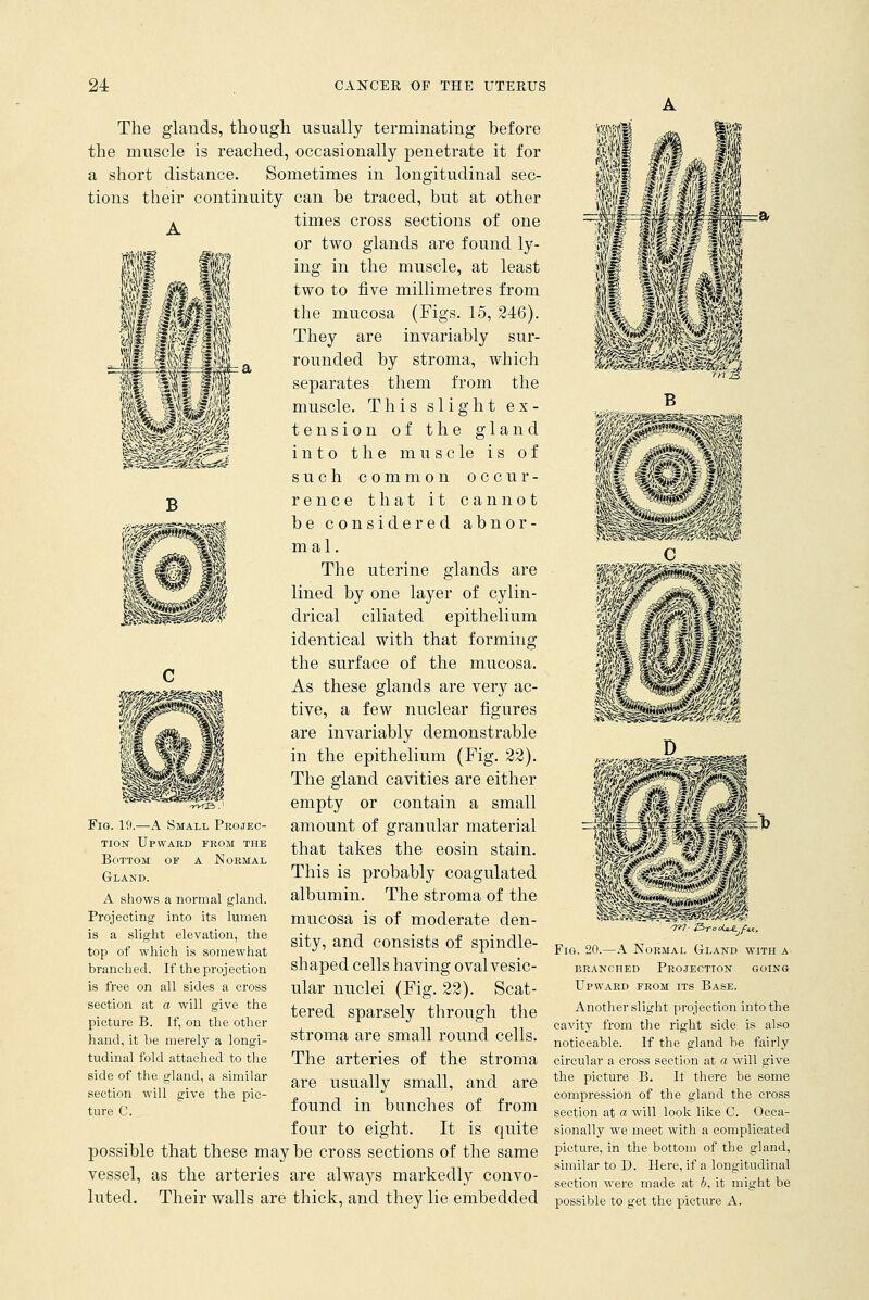jf ■H# 1W The glands, though usually terminating before the muscle is reached, occasionally penetrate it for a short distance. Sometimes in longitudinal sec- tions their continuity can be traced, but at other a times cross sections of one or two glands are found ly- ing in the muscle, at least two to five millimetres from the mucosa (Figs. 15, 246). They are invariably sur- rounded by stroma, which separates them from the muscle. This slight ex- tension of the gland into the muscle is of such common occur- rence that it cannot be considered abnor- mal. The uterine glands are lined by one layer of cylin- drical ciliated epithelium identical with that forming the surface of the mucosa. As these glands are very ac- tive, a few nuclear figures are invariably demonstrable in the epithelium (Fig. 22). The gland cavities are either empty or contain a small amount of granular material that takes the eosin stain. This is probably coagulated albumin. The stroma of the mucosa is of moderate den- sity, and consists of spindle- shaped cells having oval vesic- ular nuclei (Fig. 22). Scat- tered sparsely through the stroma are small round cells. The arteries of the stroma are usually small, and are found in bunches of from four to eight. It is quite possible that these may be cross sections of the same vessel, as the arteries are always markedly convo- luted. Their walls are thick, and they lie embedded Fig. 19.—A Small Projec- tion Upward from the Bottom of a Normal Gland. A shows a normal gland. Projecting into its lumen is a slight elevation, the top of which is somewhat branch eel. If the proj ection is free on all sides a cross section at a will give the picture B. If, on the other hand, it be merely a longi- tudinal fold attached to the side of the gland, a similar section will give the pic- ture C. Fig. 20.—A Normal Gland with a branched projection going Upward from its Base. Another slight projection into the cavity from the right side is also noticeable. If the gland be fairly circular a cross section at a will give the picture B. If there be some compression of the gland the cross section at a will look like C. Occa- sionally we meet with a complicated picture, in the bottom of the gland, similar to D. Here, if a longitudinal section were made at i, it might be possible to get the picture A.
