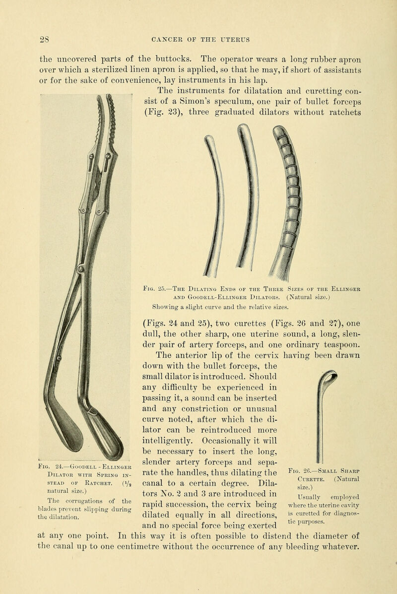 the uncovered parts of the buttocks. The operator wears a long rubber apron over which a sterilized linen apron is applied, so that he may, if short of assistants or for the sake of convenience, lay instruments in his lap. The instruments for dilatation and curetting con- sist of a Simon's speculum, one pair of bullet forceps (Fig. 23), three graduated dilators without ratchets Fig. 25.—The Dilating Ends of the Three Sizes of the Ellingee and Goodell-Ellingee Dilatoes. (Natural size.) Showing a slight curve and the relative sizes. (Figs. 24 and 25), two curettes (Figs. 26 and 27), one dull, the other sharp, one uterine sound, a long, slen- der pair of artery forceps, and one ordinary teaspoon. The anterior lip of the cervix having been drawn down with the bullet forceps, the small dilator is introduced. Should any difficulty be experienced in passing it, a sound can be inserted and any constriction or unusual curve noted, after which the di- lator can be reintroduced more intelligently. Occasionally it will be necessary to insert the long, slender artery forceps and sepa- rate the handles, thus dilating the canal to a certain degree. Dila- tors No. 2 and 3 are introduced in rapid succession, the cervix being dilated equally in all directions, and no special force being exerted at any one point. In this way it is often possible to distend the diameter of the canal up to one centimetre without the occurrence of any bleeding whatever. Fig. 24.—Goodell-Ellingee Dilatob with. Spring in- stead of Ratchet. (i/2 natural size.) The corrugations of the blades prevent slipping during the dilatation. Fig. 26.—Small Shaep Curette. (Natural size.) Usually employed where the uterine cavity is curetted for diagnos- tic purposes.
