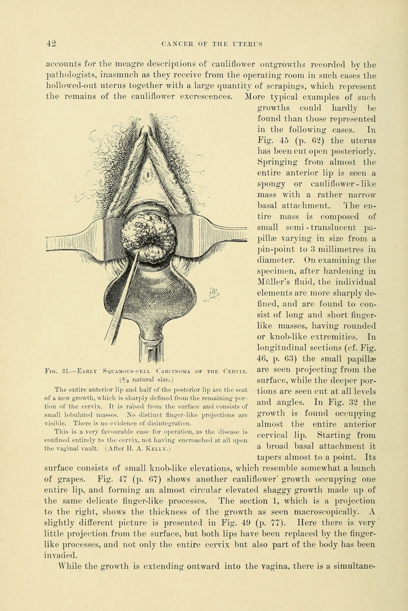 accounts for the meagre descriptions of cauliflower outgrowths recorded by the pathologists, inasmuch as they receive from the operating room in such cases the hollowed-out uterus together with a large quantity of scrapings, which represent the remains of the cauliflower excrescences. More typical examples of such growths could hardly be found than those represented in the following cases. In Fig. 45 (p. 62) the uterus has been cut open posteriorly. Springing from almost the entire anterior lip is seen a spongy or cauliflower - like mass with a rather narrow basal attachment. The en- tire mass is composed of small semi - translucent pa- pill se varying in size from a pin-point to 3 millimetres in diameter. On examining the specimen, after hardening in Midler's fluid, the individual elements are more sharply de- fined, and are found to con- sist of long and short finger- like masses, having rounded or knob-like extremities. In longitudinal sections (cf. Fig. 46, p. 63) the small papilla? are seen projecting from the surface, while the deeper por- tions are seen cut at all levels and angles. In Fig. 32 the growth is found occupying almost the entire anterior cervical lip. Starting from a broad basal attachment it tapers almost to a point. Its surface consists of small knob-like elevations, which resemble somewhat a bunch of grapes. Fig. 47 (p. 67) shows another cauliflower' growth occupying one entire lip, and forming an almost circular elevated shaggy growth made up of the same delicate finger-like processes. The section 1, which is a projection to the right, shows the thickness of the growth as seen macroscopically. A slightly different picture is presented in Fig. 49 (p. 77). Here there is very little projection from the surface, but both lips have been replaced by the finger- like processes, and not only the entire cervix but also part of the body has been invaded. While the growth is extending outward into the vagina, there is a simultane- Fig. 31.—Eaely Sqtjamous-cell Carcinoma of the Cervix. (2/3 natural size.) The entire anterior lip and half of the posterior lip are the seat of a new growth, which is sharply defined from the remaining por- tion of the cervix. It is raised from the surface and consists of small lobulated masses. No distinct finger-like projections are visible. There is no evidence of disintegration. This is a very favourable case for operation, as the disease is confined entirely to the cervix, not having encroached at all upon the vaginal vault. (After H. A. Kelly.)