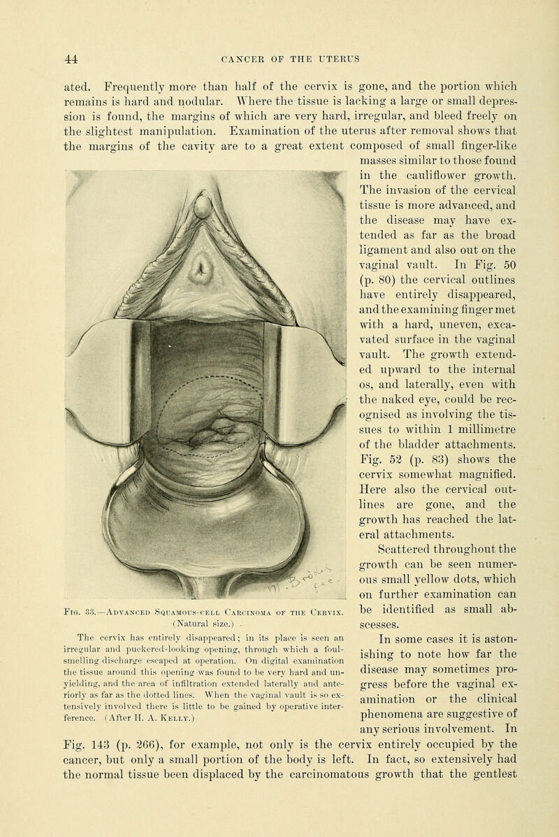 vY: .-' -■' ated. Frequently more than half of the cervix is gone, and the portion which remains is hard and nodular. Where the tissue is lacking a large or small depres- sion is found, the margins of which are very hard, irregular, and bleed freely on the slightest manipulation. Examination of the uterus after removal shows that the margins of the cavity are to a great extent composed of small finger-like masses similar to those found fgT in the cauliflower growth. The invasion of the cervical tissue is more advanced, and the disease may have ex- tended as far as the broad ligament and also out on the vaginal vault. In Fig. 50 (p. 80) the cervical outlines have entirely disappeared, and the examining finger met with a hard, uneven, exca- vated surface in the vaginal vault. The growth extend- ed upward to the internal os, and laterally, even with the naked eye, could be rec- ognised as involving the tis- sues to within 1 millimetre of the bladder attachments. Fig. 52 (p. 83) shows the cervix somewhat magnified. Here also the cervical out- lines are gone, and the growth has reached the lat- eral attachments. Scattered throughout the growth can be seen numer- ous small yellow dots, which on further examination can be identified as small ab- scesses. In some cases it is aston- ishing to note how far the disease may sometimes pro- gress before the vaginal ex- amination or the clinical phenomena are suggestive of any serious involvement. In Fig. 143 (p. 266), for example, not only is the cervix entirely occupied by the cancer, but only a small portion of the body is left. In fact, so extensively had the normal tissue been displaced by the carcinomatous growth that the gentlest V Fig. 33.—Advanced Squamous-cell Carcinoma of the Cervix. (Natural size.) - The cervix has entirely disappeared; in its place is seen an irregular and puckered-looking opening, through which a foul- smelling discharge escaped at operation. On digital examination the tissue around this opening was found to be very hard and un- yielding, and the area of infiltration extended laterally and ante- riorly as far as the dotted lines. When the vaginal vault is so ex- tensively involved there is little to be gained by operative inter- ference. (After H. A. Kelly.)
